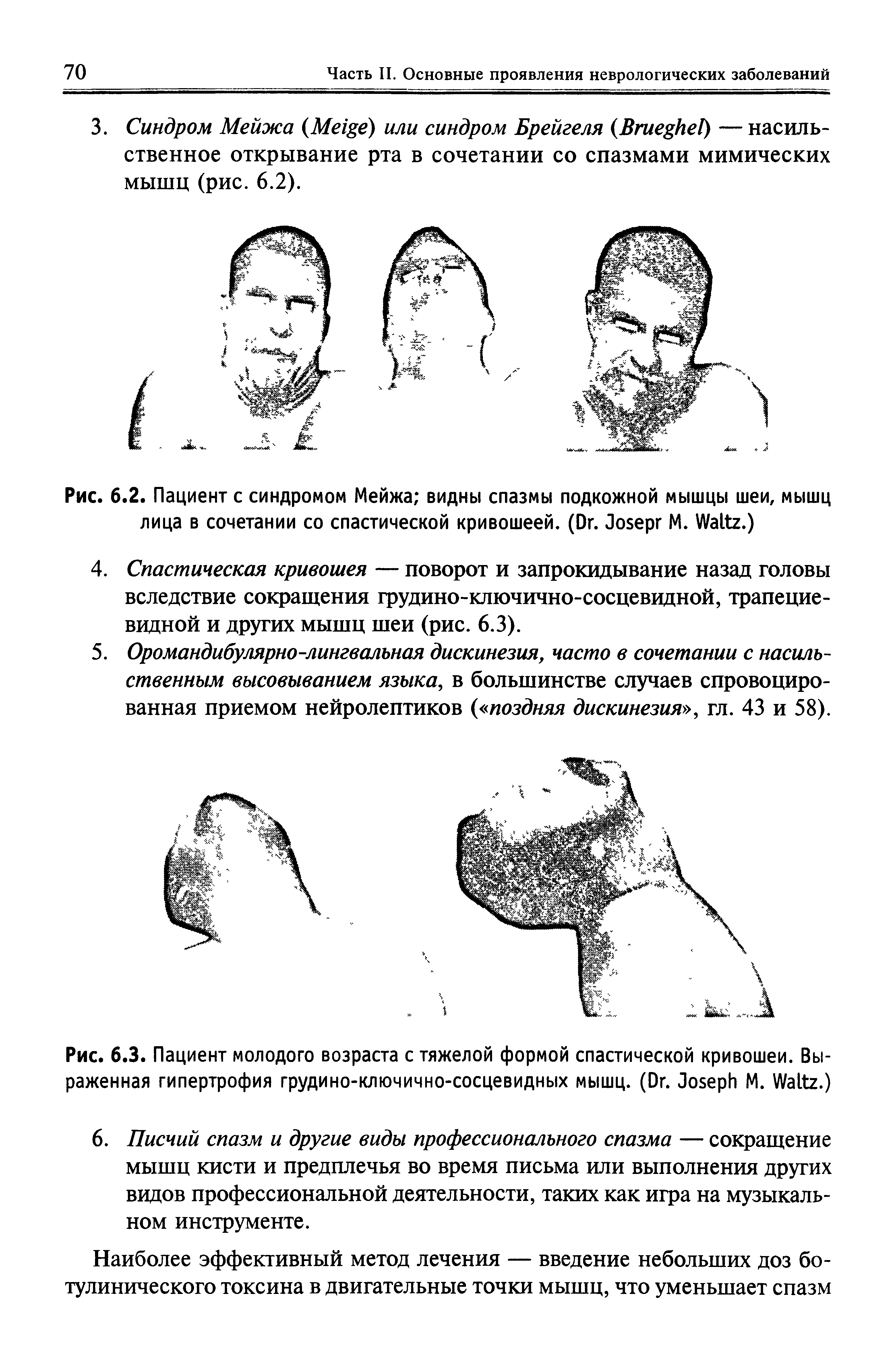 Рис. 6.2. Пациент с синдромом Мейжа видны спазмы подкожной мышцы шеи, мышц лица в сочетании со спастической кривошеей. (D . J М. W .)...