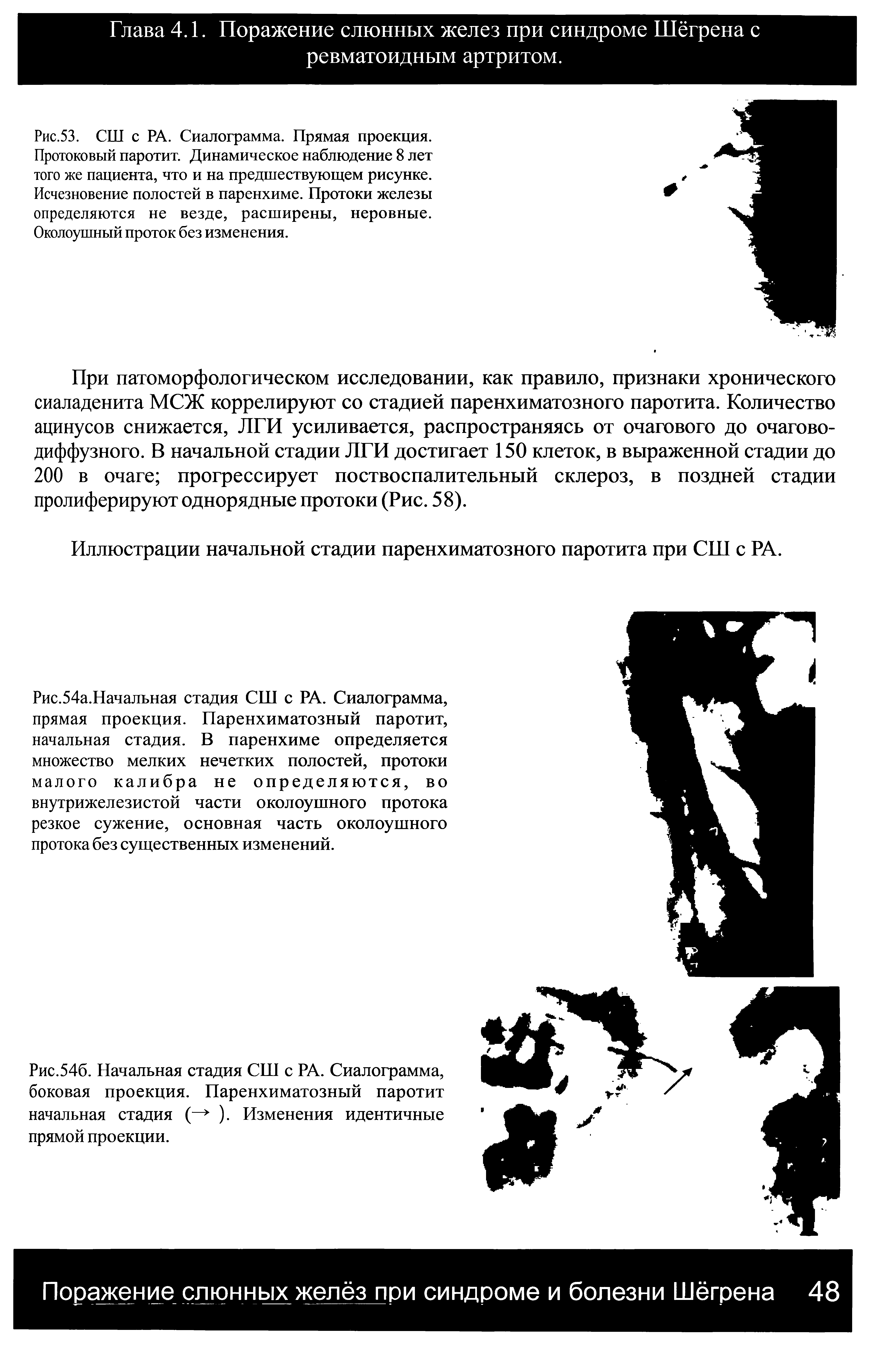 Рис.54а.Начальная стадия СШ с РА. Сиалограмма, прямая проекция. Паренхиматозный паротит, начальная стадия. В паренхиме определяется множество мелких нечетких полостей, протоки малого калибра не определяются, во внутрижелезистой части околоушного протока резкое сужение, основная часть околоушного протока без существенных изменений.