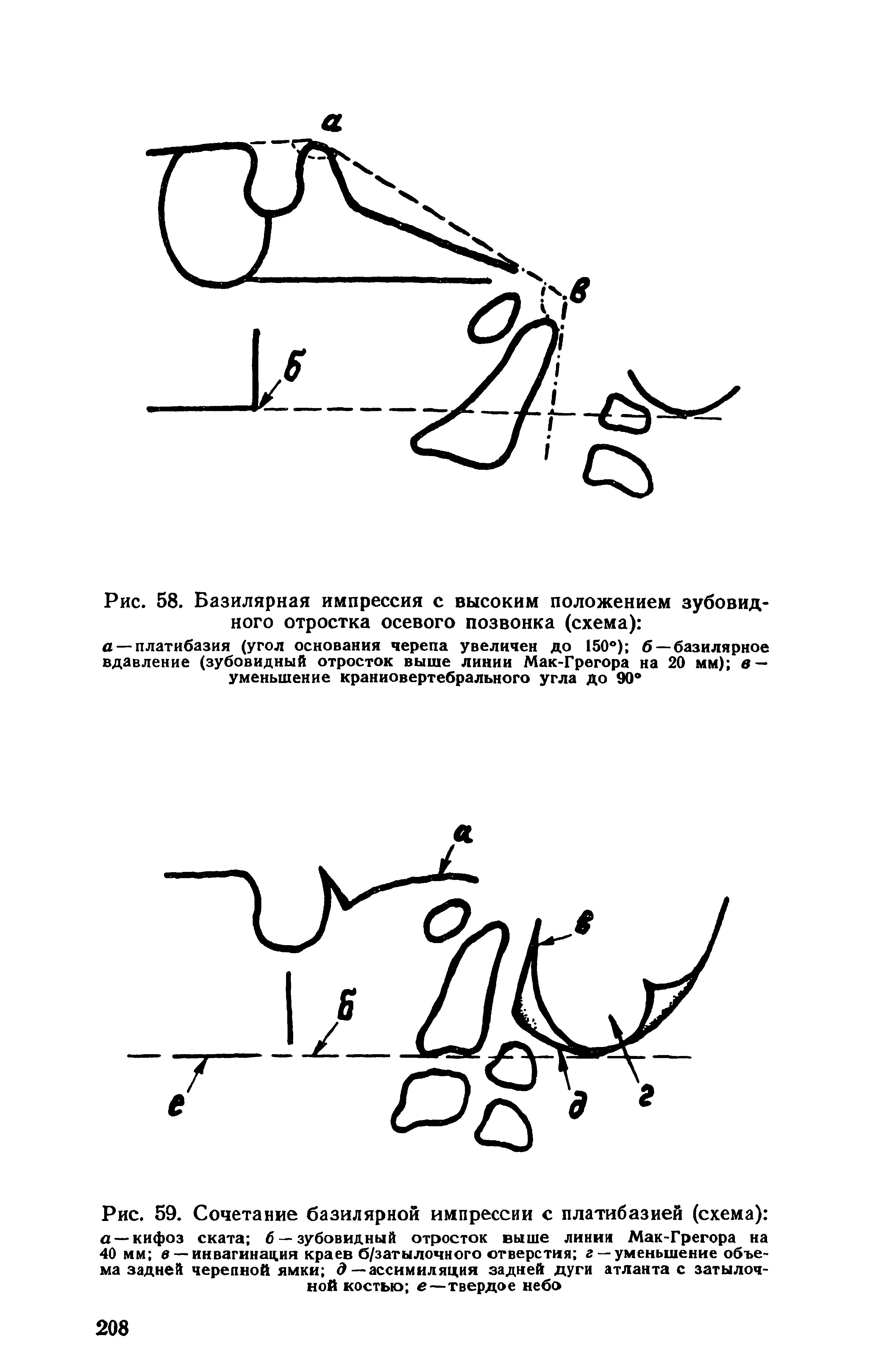 Рис. 59. Сочетание базилярной импрессии с платибазией (схема) а —кифоз ската б —зубовидный отросток выше линии Мак-Грегора на 40 мм в —инвагинация краев б/затылочного отверстия г —уменьшение объема задней черепной ямки д—ассимиляция задней дуги атланта с затылочной костью е—твердое небо...