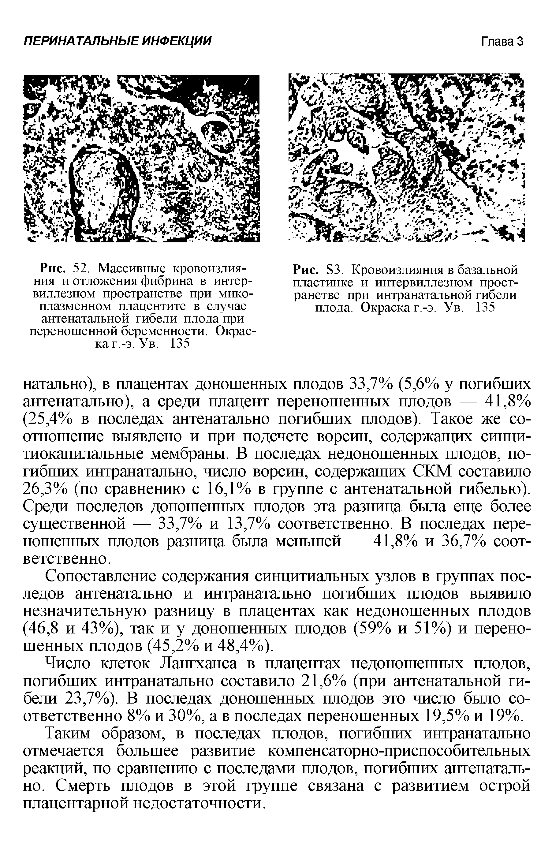 Рис. 52. Массивные кровоизлияния и отложения фибрина в интер-виллезном пространстве при микоплазменном плацентите в случае антенатальной гибели плода при переношенной беременности. Окраска г.-э.Ув. 135...