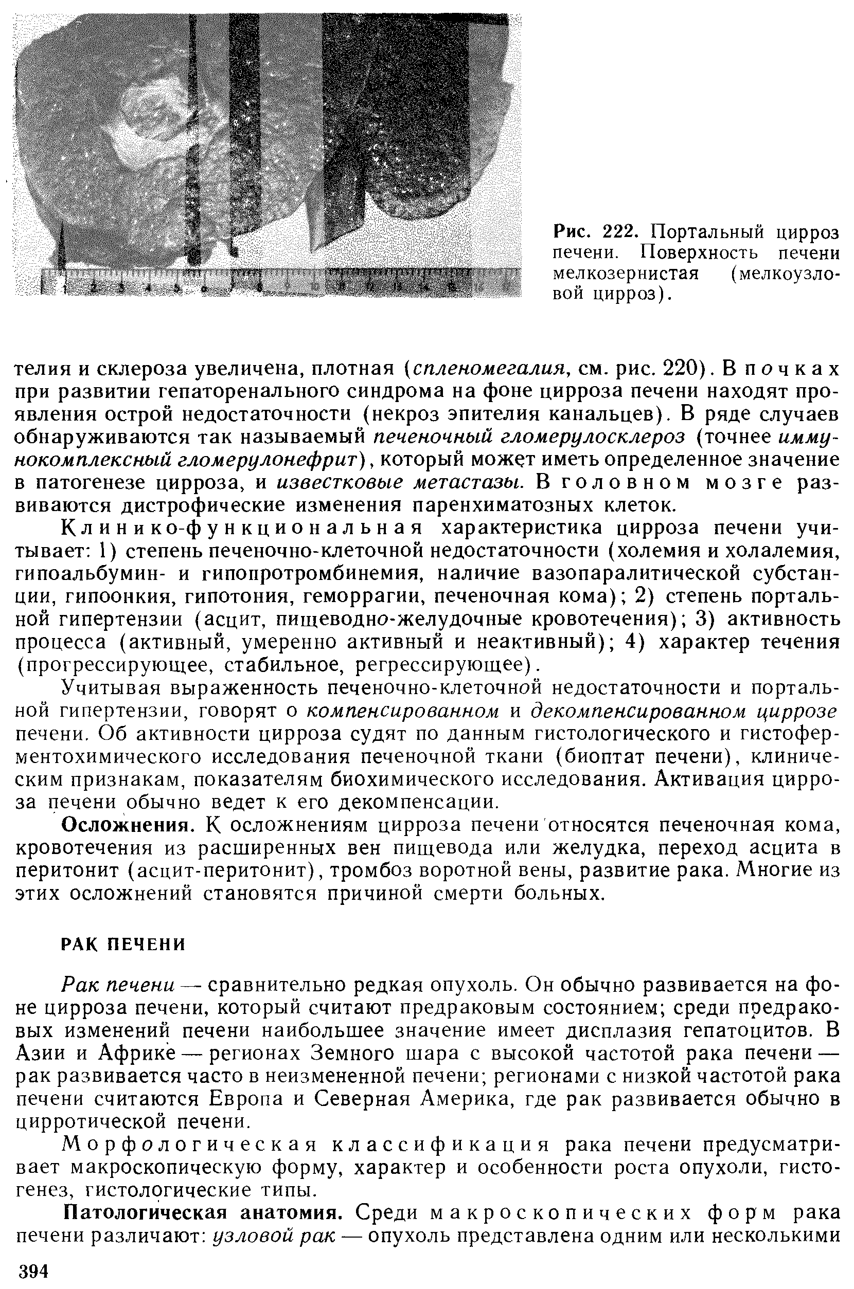 Рис. 222. Портальный цирроз печени. Поверхность печени мелкозернистая (мелкоузловой цирроз).