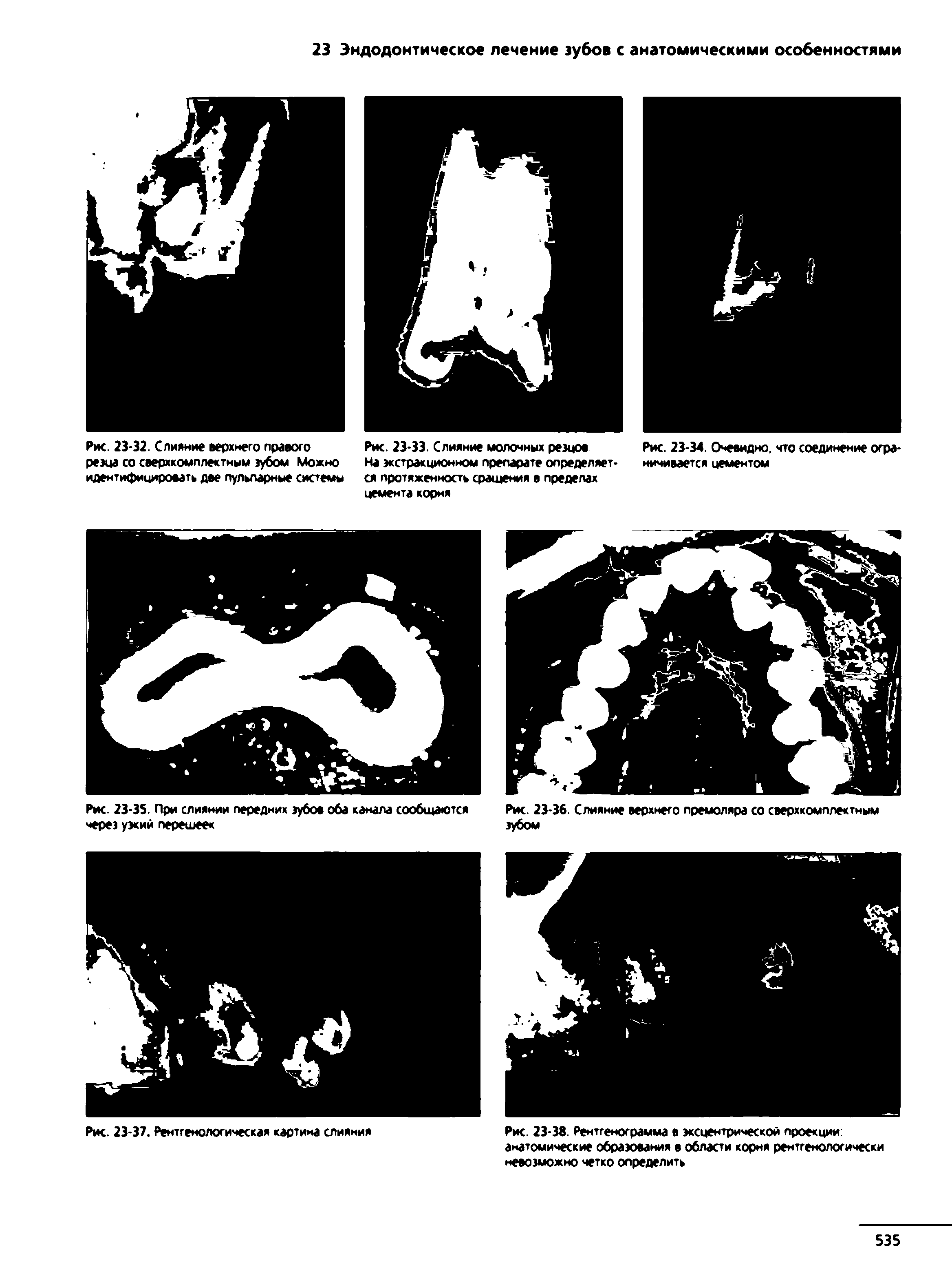Рис. 23-33. Слияние молочных резцов На экстракционном препарате определяется протяженность сращения в пределах цемента корня...