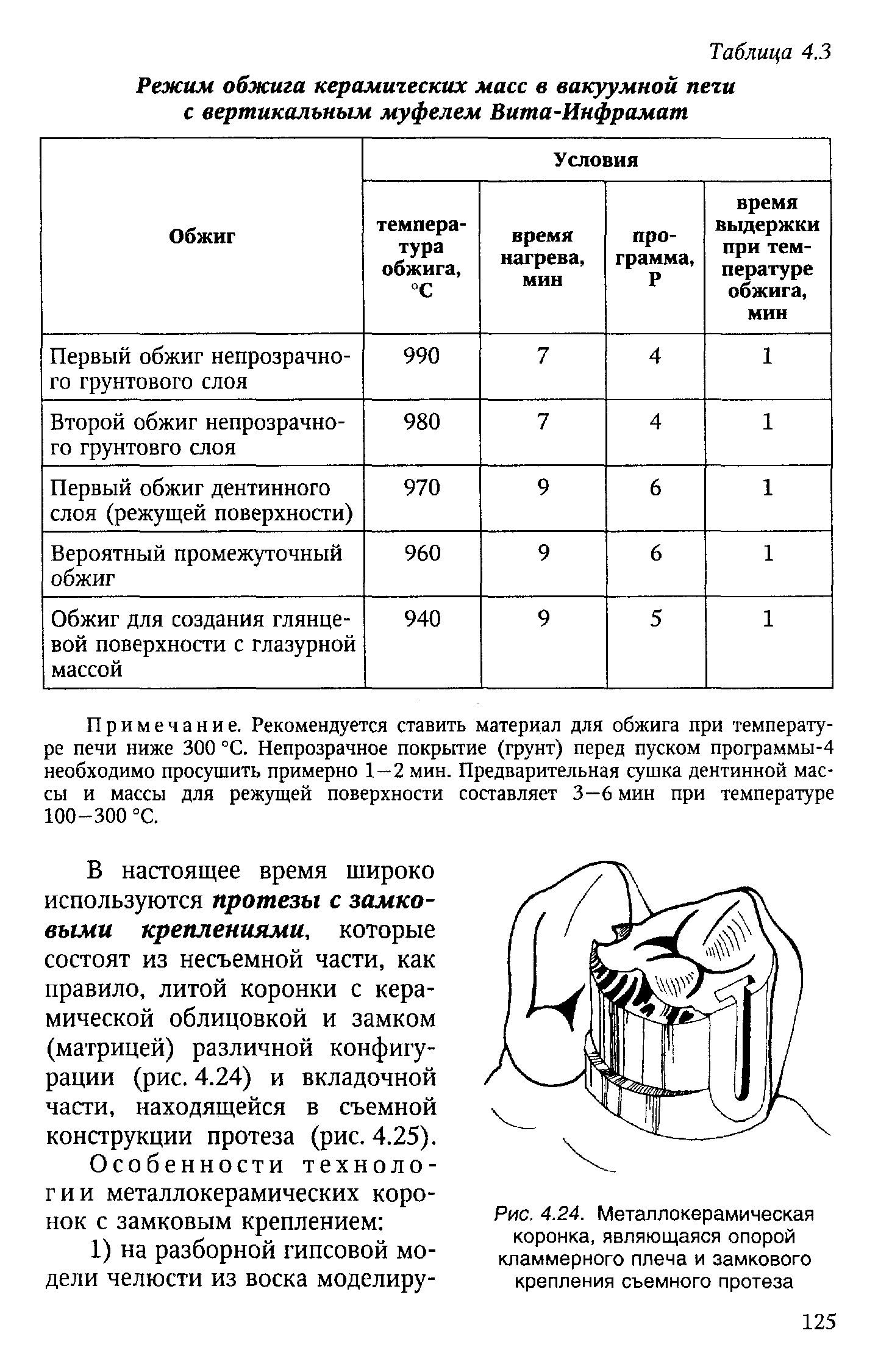 Рис. 4.24. Металлокерамическая коронка, являющаяся опорой кламмерного плеча и замкового крепления съемного протеза...