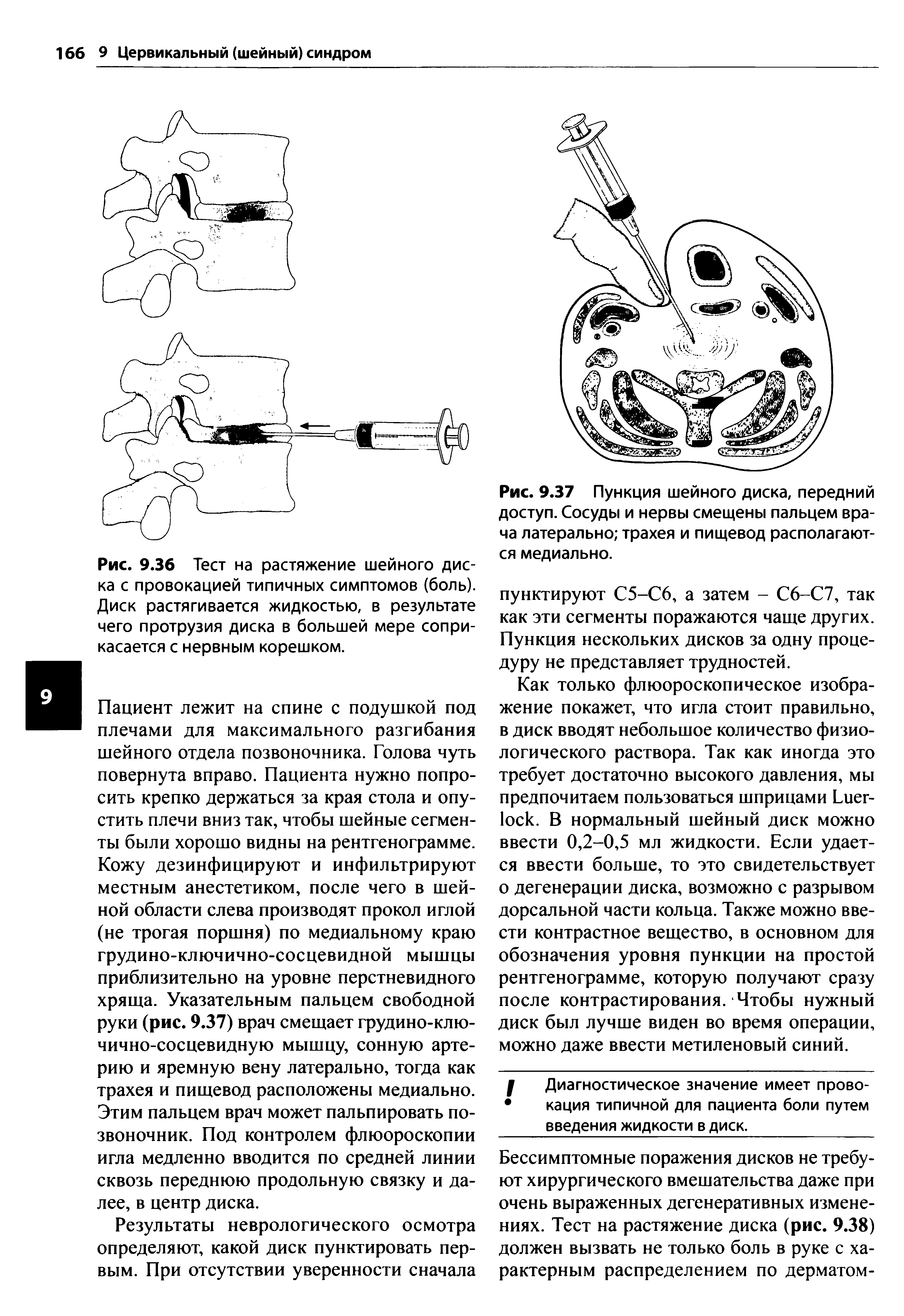 Рис. 9.36 Тест на растяжение шейного диска с провокацией типичных симптомов (боль). Диск растягивается жидкостью, в результате чего протрузия диска в большей мере соприкасается с нервным корешком.
