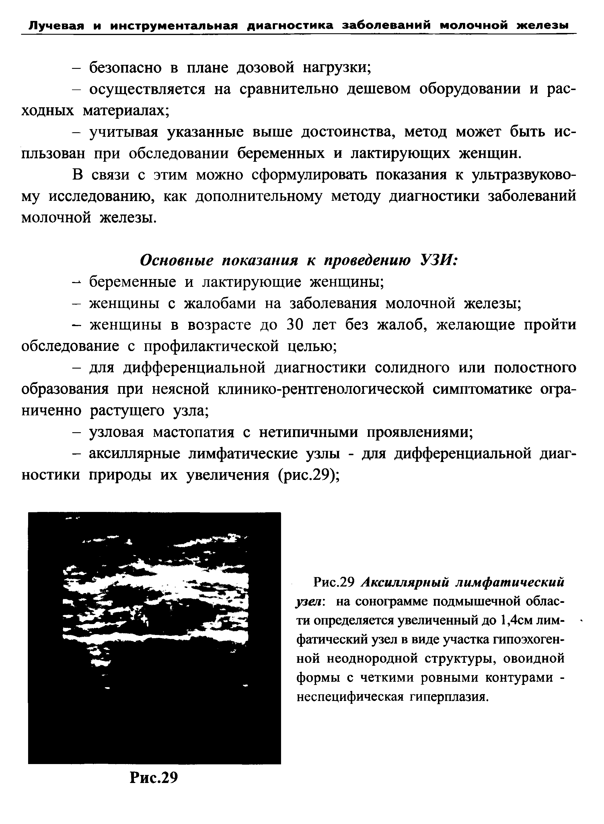 Рис.29 Аксиллярный лимфатический узел, на сонограмме подмышечной области определяется увеличенный до 1,4см лимфатический узел в виде участка гипоэхоген-ной неоднородной структуры, овоидной формы с четкими ровными контурами -неспецифическая гиперплазия.