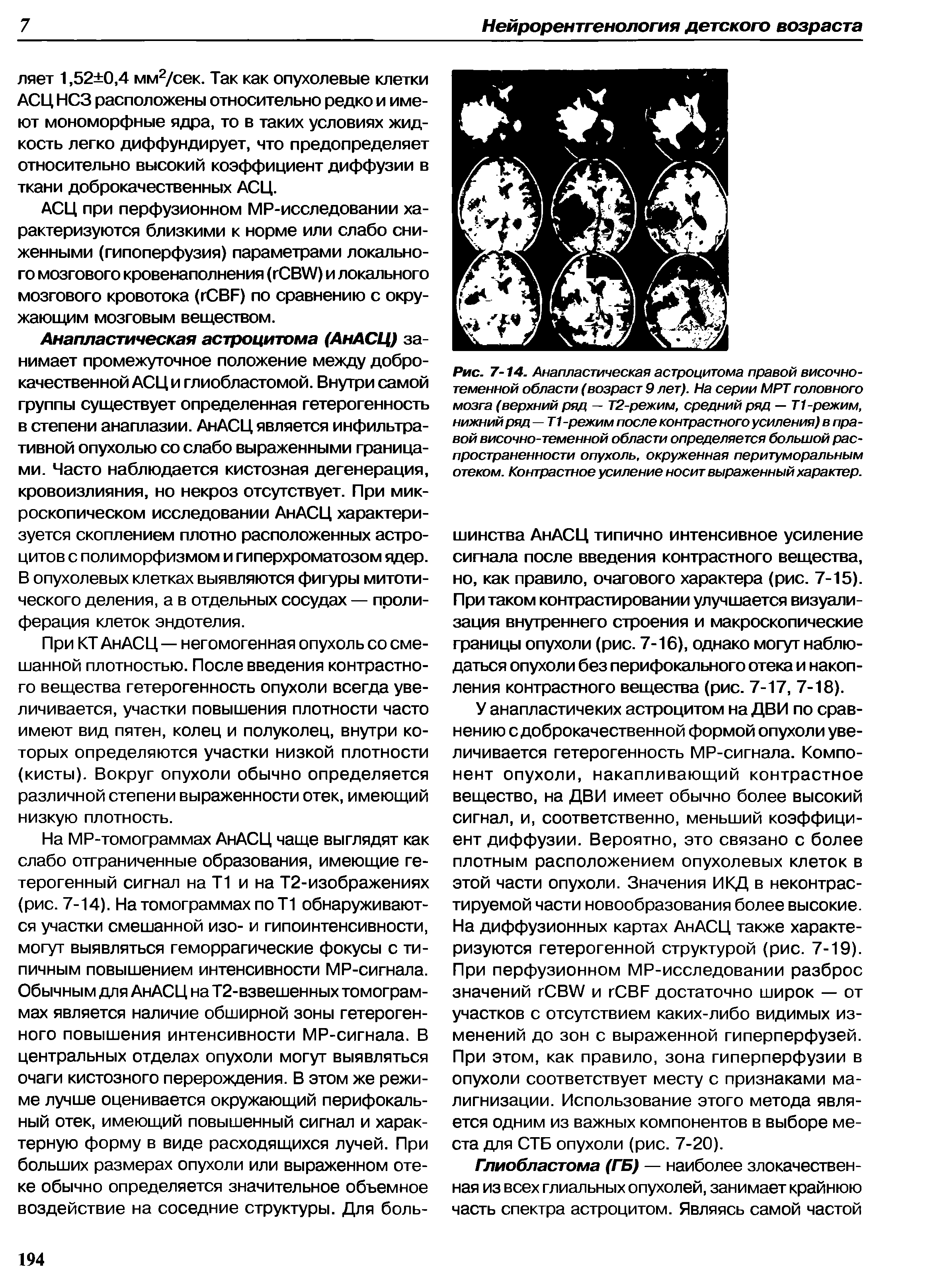 Рис. 7-14. Анапластическая астроцитома правой височнотеменной области (возраст 9 лет). На серии МРТ головного мозга (верхний ряд — Т2-режим, средний ряд — Т1-режим, нижний ряд—Т1 -режим после контрастного усиления) в правой височно-теменной области определяется большой распространенности опухоль, окруженная перитуморальным отеком. Контрастное усиление носит выраженный характер.