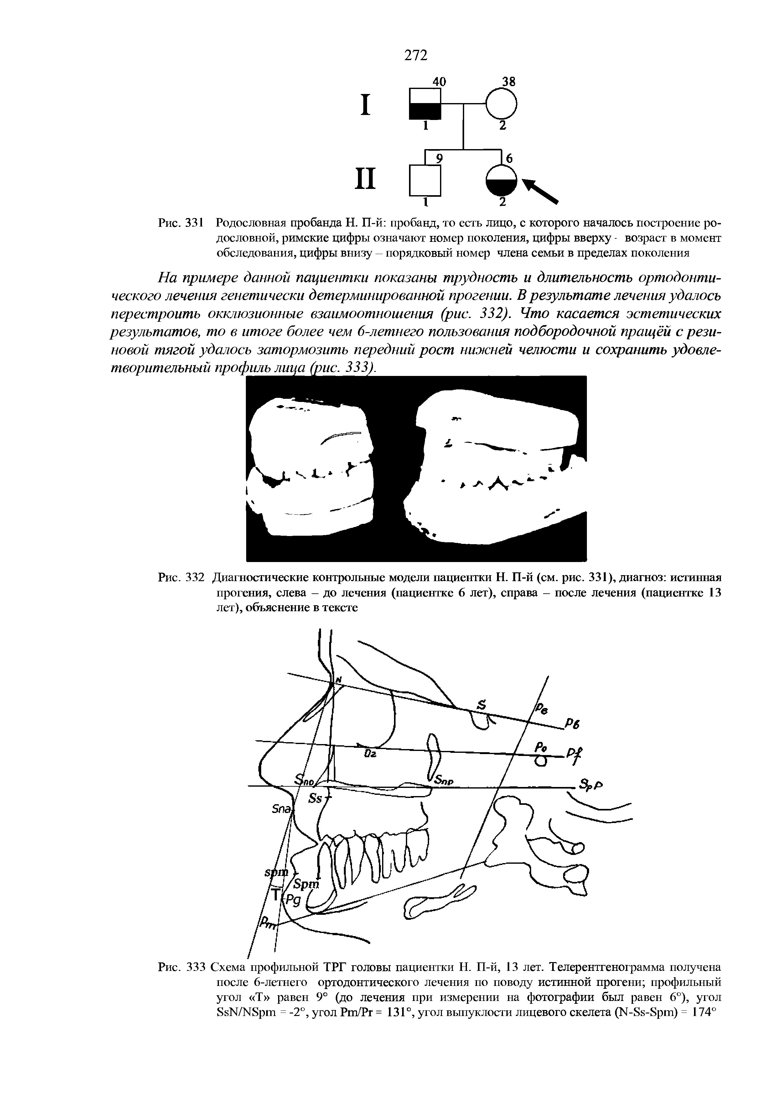 Рис. 333 Схема профильной ТРГ головы пациентки Н. П-й, 13 лет. Телерентгенограмма получена после 6-летнего ортодонтического лечения по поводу истинной прогени профильный угол Т равен 9° (до лечения при измерении на фотографии был равен 6°), угол 8кМ/Н8р1п = -2°, угол Рт/Рг = 131°, угол выпуклости лицевого скелета (М-8к-8р1п) = 174°...