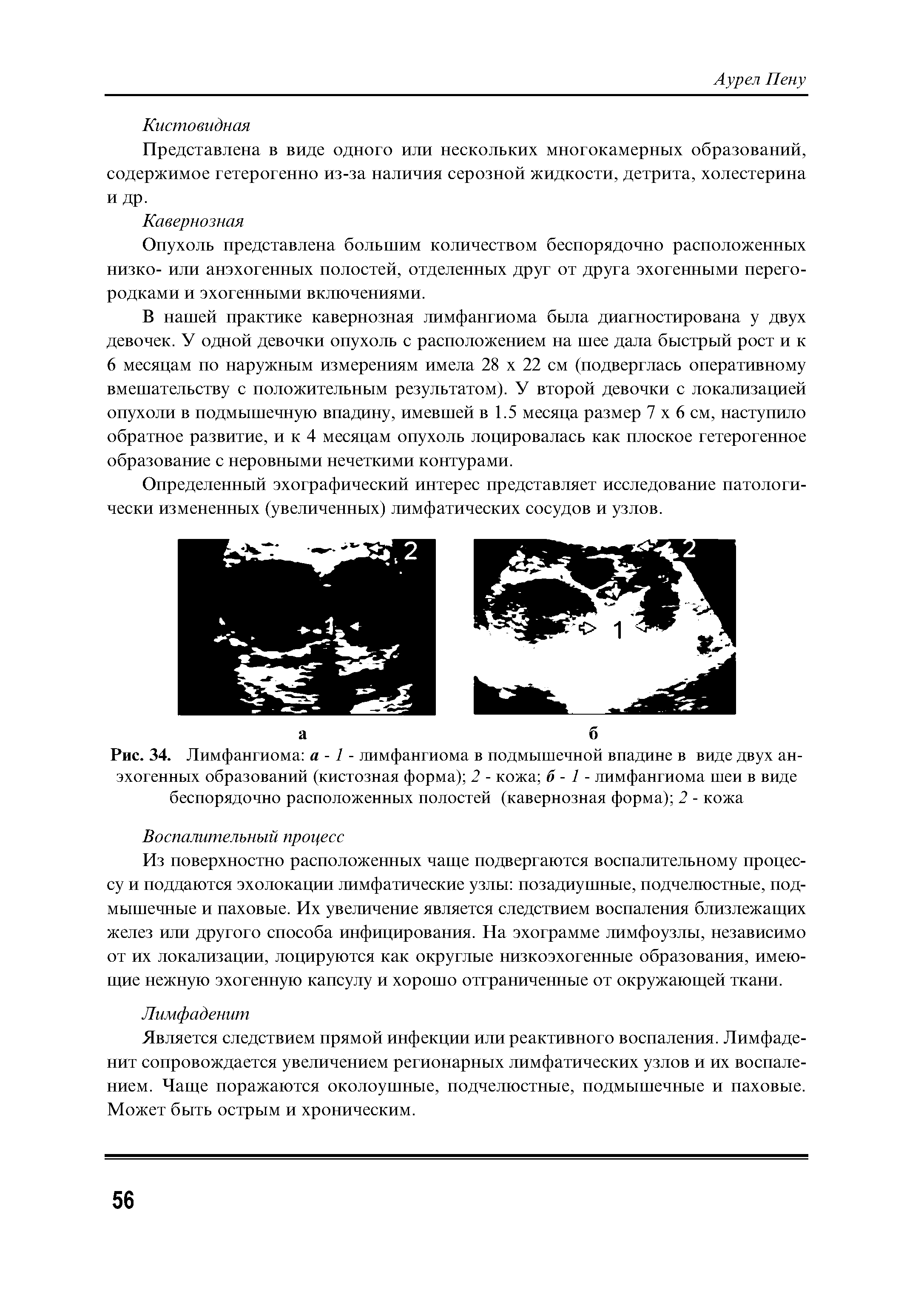 Рис. 34. Лимфангиома а -1 - лимфангиома в подмышечной впадине в виде двух анэхогенных образований (кистозная форма) 2 - кожа б - 1 - лимфангиома шеи в виде беспорядочно расположенных полостей (кавернозная форма) 2 - кожа...