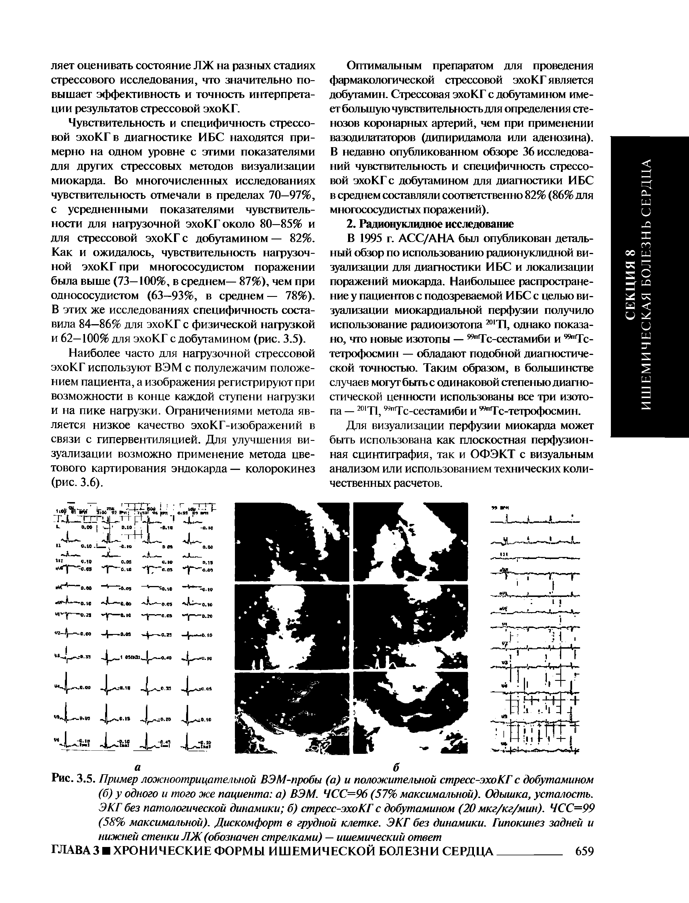 Рис. 3.5. Пример ложноотрицателъной ВЭМ-пробы (а) и положительной стресс-эхоКГ с добутамином (б) у одного и того же пациента а) ВЭМ. ЧСС=96 (57% максимальной). Одышка, усталость. ЭКГ без патологической динамики б) стресс-эхоКГ с добутамином (20 мкг/кг/мин). ЧСС=99 (58%> максимальной). Дискомфорт в грудной клетке. ЭКГ без динамики. Гипокинез задней и нижней стенки ЛЖ (обозначен стрелками) — ишемический ответ...
