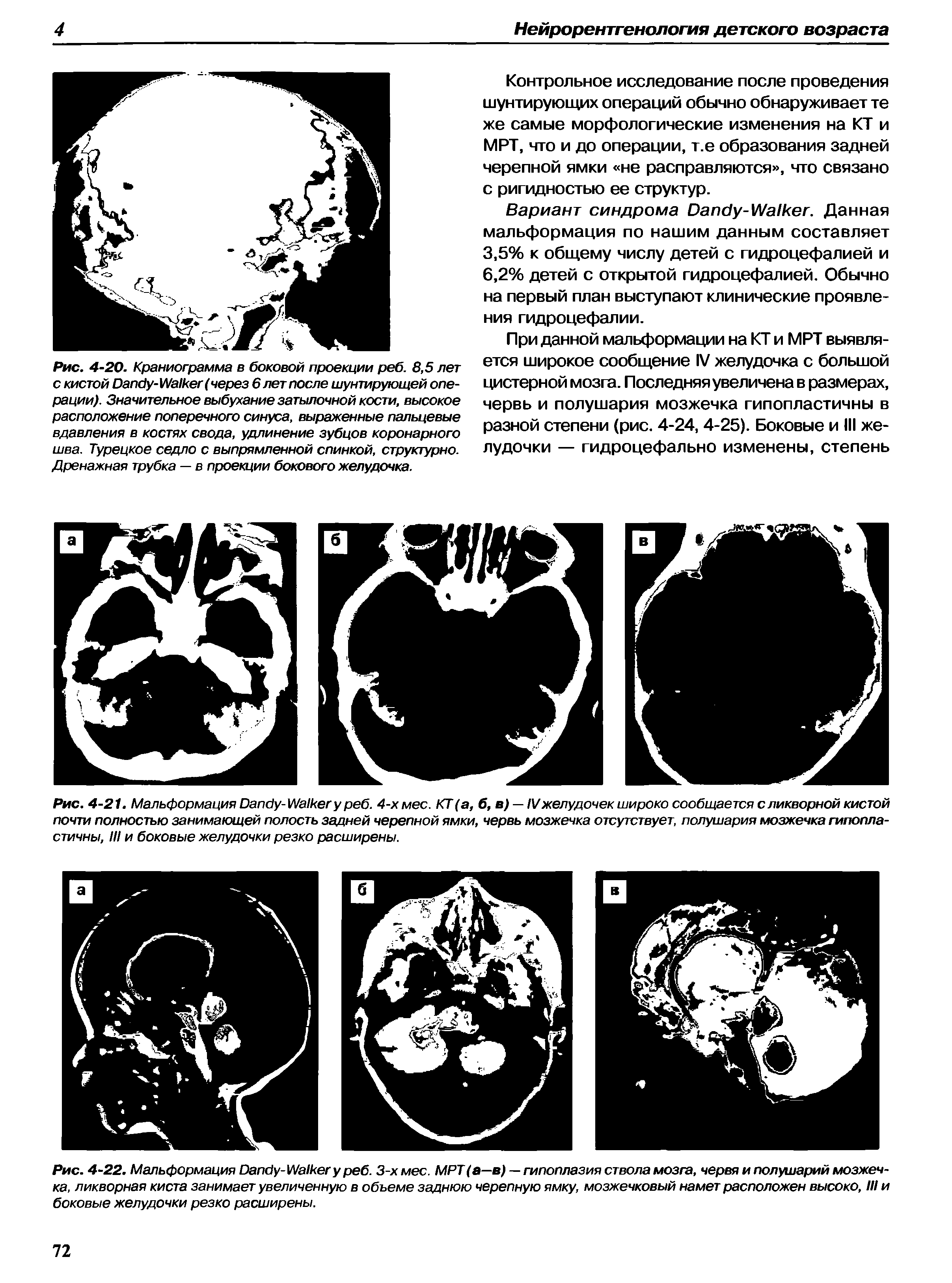 Рис. 4-21. Мальформация D -W 6. 4-х мес. КТ (а, б, в) — IVжелудочек широко сообщается с ликворной кистой почти полностью занимающей полость задней черепной ямки, червь мозжечка отсутствует, полушария мозжечка гипопластичны, III и боковые желудочки резко расширены.