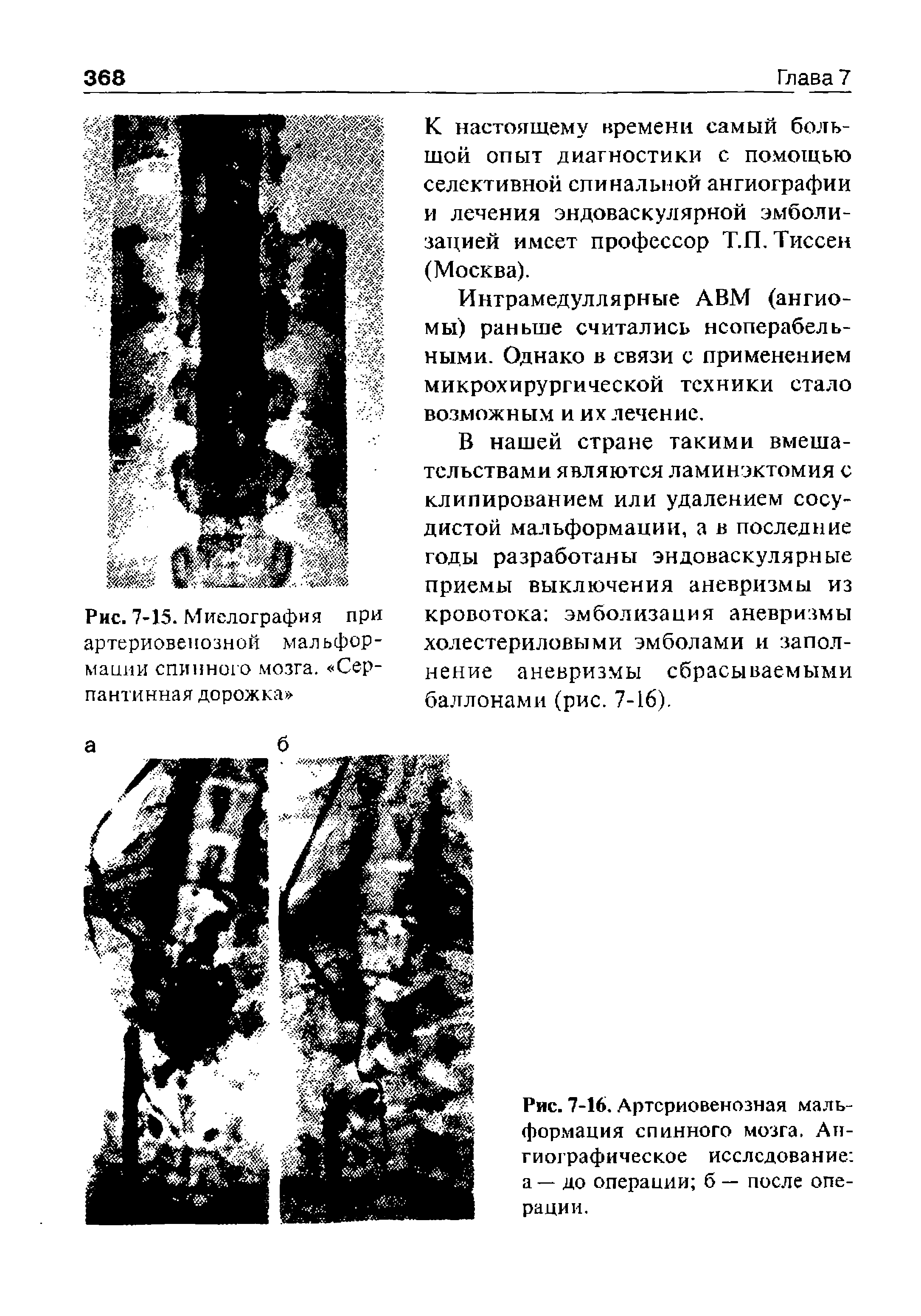 Рис. 7-16. Артериовенозная мальформация спинного мозга. Ангиографическое исследование а — до операции б — после операции.