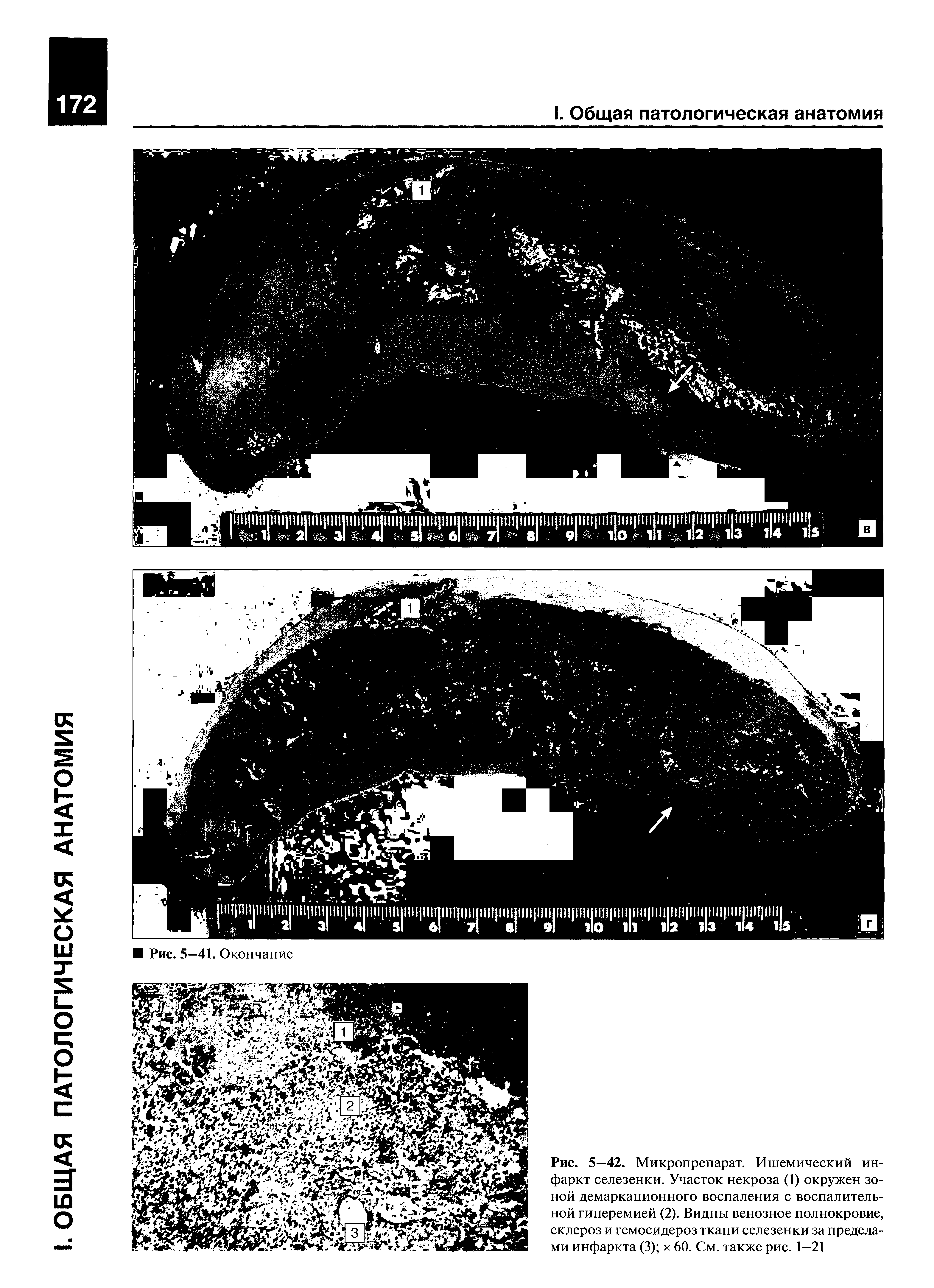 Рис. 5—42. Микропрепарат. Ишемический инфаркт селезенки. Участок некроза (1) окружен зоной демаркационного воспаления с воспалительной гиперемией (2). Видны венозное полнокровие, склероз и гемосидероз ткани селезенки за пределами инфаркта (3) х 60. См. также рис. 1—21...
