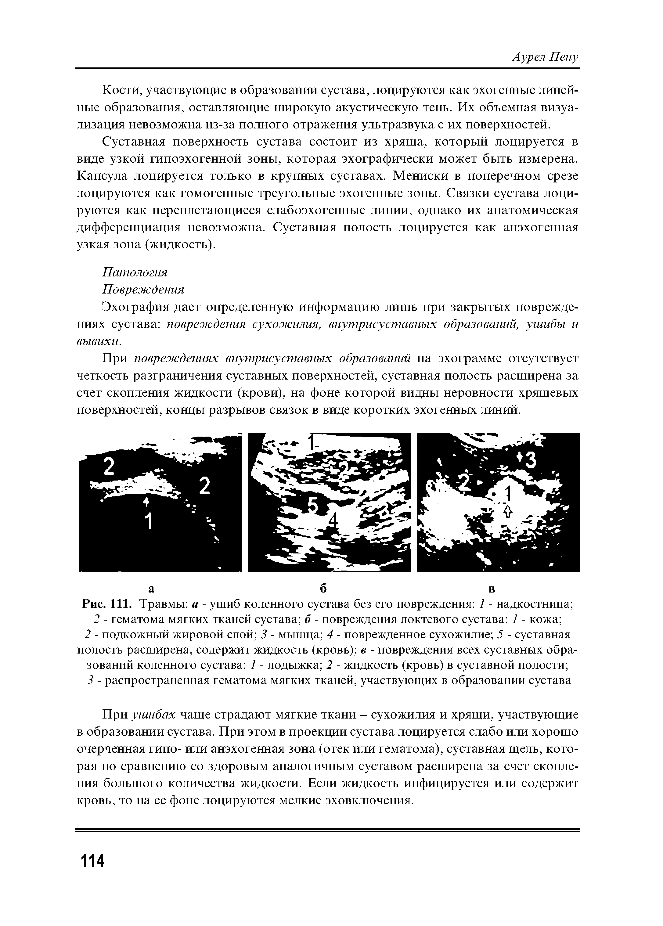 Рис. 111. Травмы а - ушиб коленного сустава без его повреждения 1 - надкостница 2 - гематома мягких тканей сустава б - повреждения локтевого сустава 1 - кожа ...