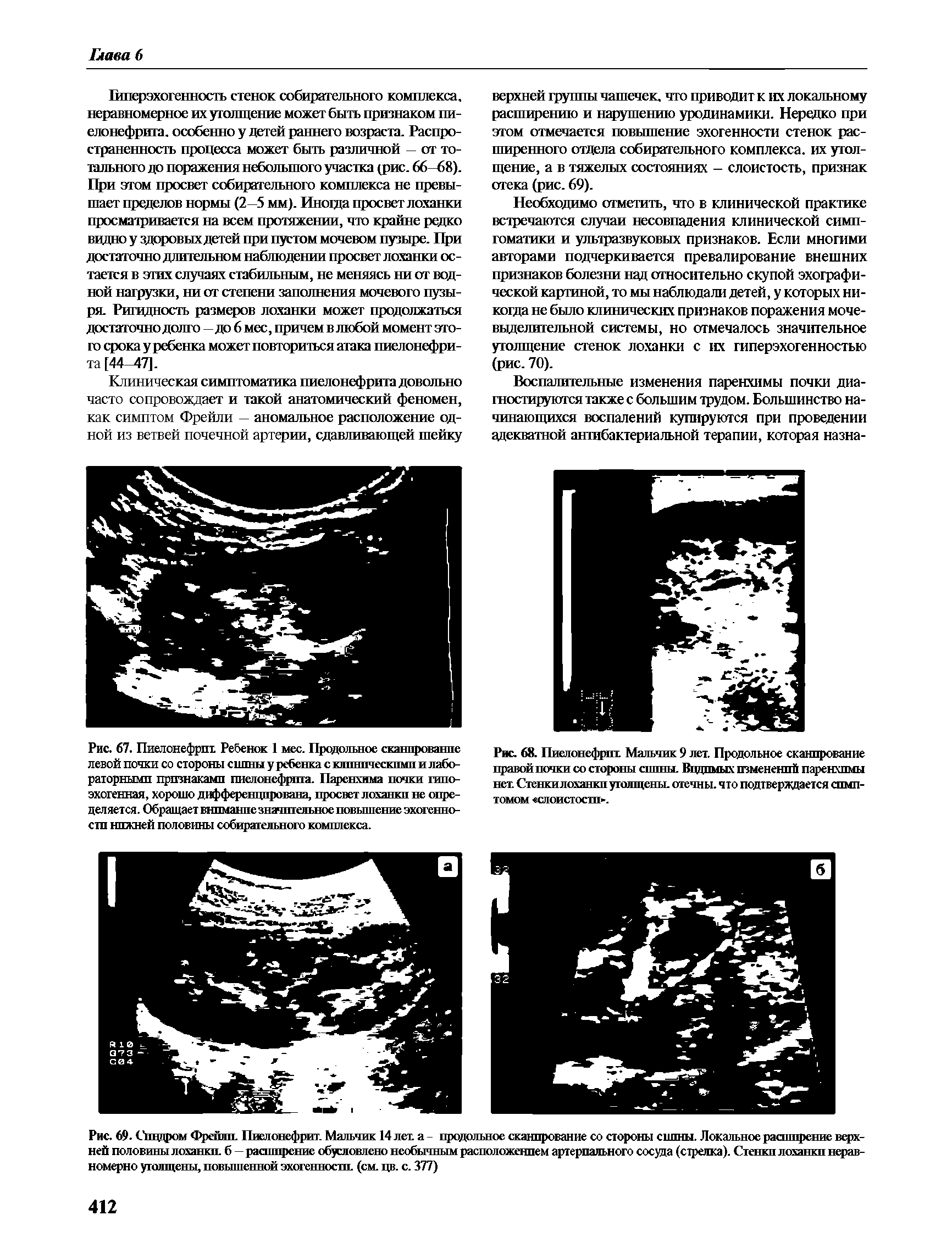 Рис. 69. Синдром Фрейли. Пиелонефрит. Мальчик 14 лет а - продольное сканирование со стороны снпны. Локальное расширение верхней половины лоханки. б — расширение обусловлено необычным расположением артериального сосуда (стрелка). Стенки лоханки неряи-номерно утолщены, повышенной эхогенности, (см. цв. с. 377)...