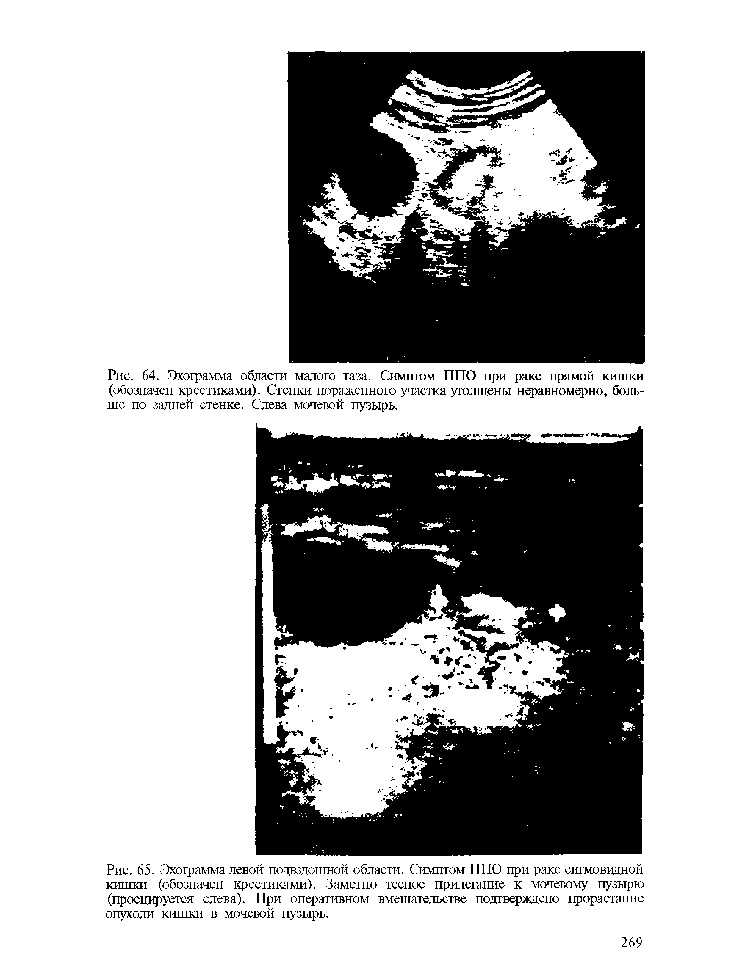 Рис. 65. Эхограмма левой подвздошной области. Симптом ППО при раке сигмовидной кишки (обозначен крестиками). Заметно тесное прилегание к мочевому пузырю (проецируется слева). При оперативном вмешательстве подтверждено прорастание опухоли кишки в мочевой пузырь.