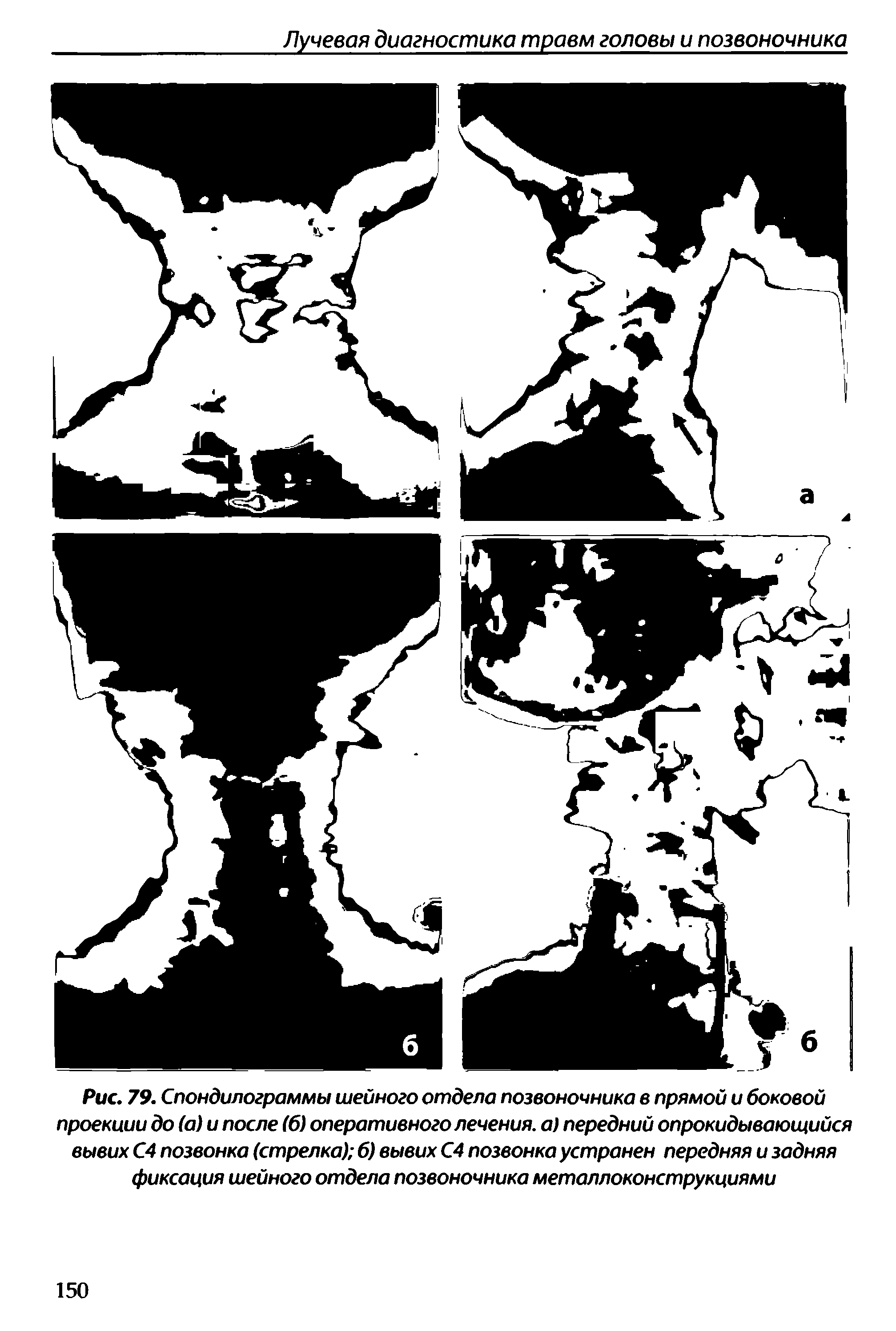 Рис. 79. Спондилограммы шейного отдела позвоночника в прямой и боковой проекиии до (а) и после (6) оперативного лечения, а) передний опрокидывающийся вывих С4 позвонка (стрелка) б) вывих С4 позвонка устранен передняя и задняя фиксация шейного отдела позвоночника металлоконструкциями...