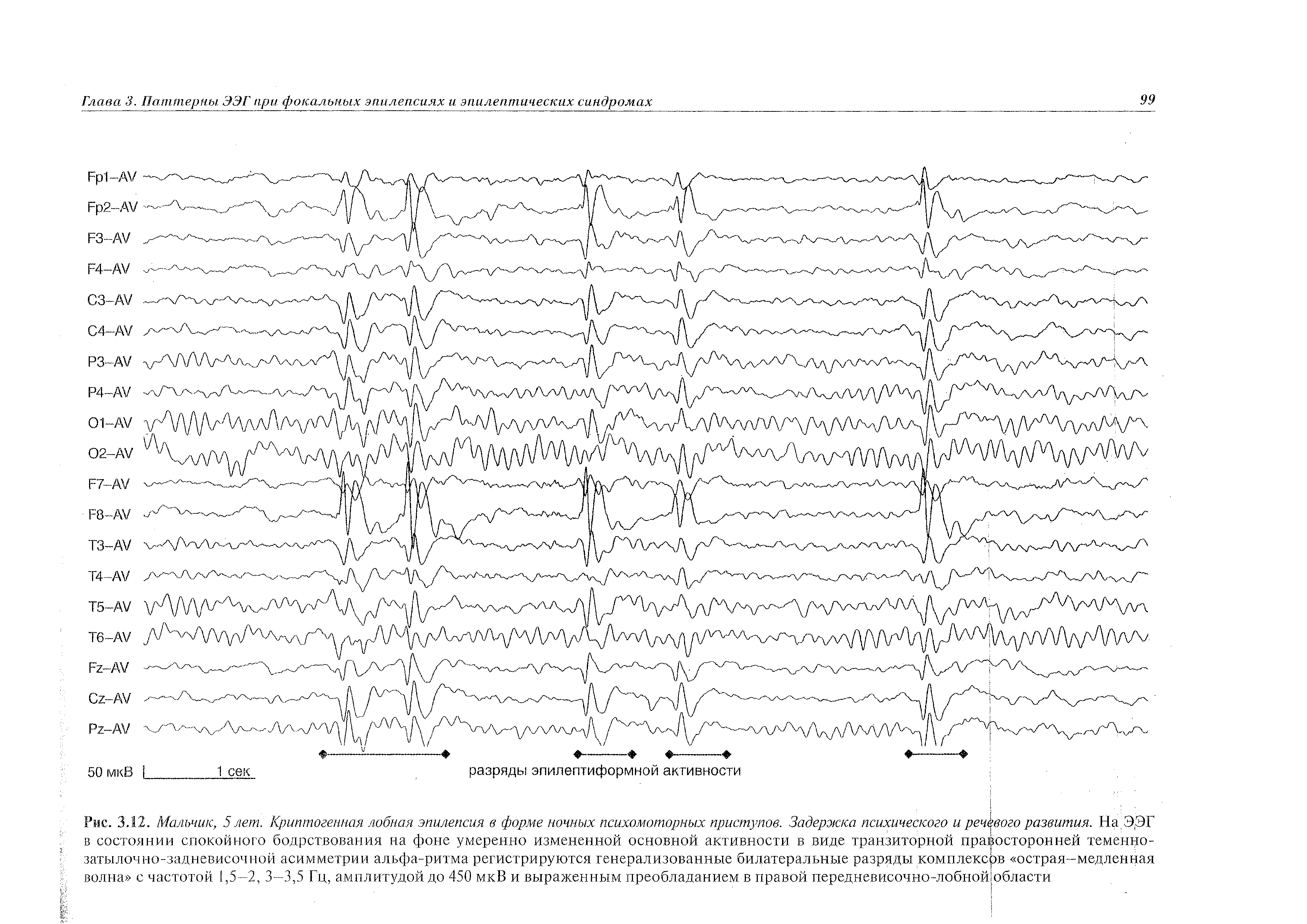 Рис. 3.12. Мальчик, 5 лет. Криптогенная лобная эпилепсия в форме ночных психомоторных приступов. Задержка психического и речевого развития. На.Э.ЭГ в состоянии спокойного бодрствования на фоне умеренно измененной основной активности в виде транзиторной правосторонней теменно-...