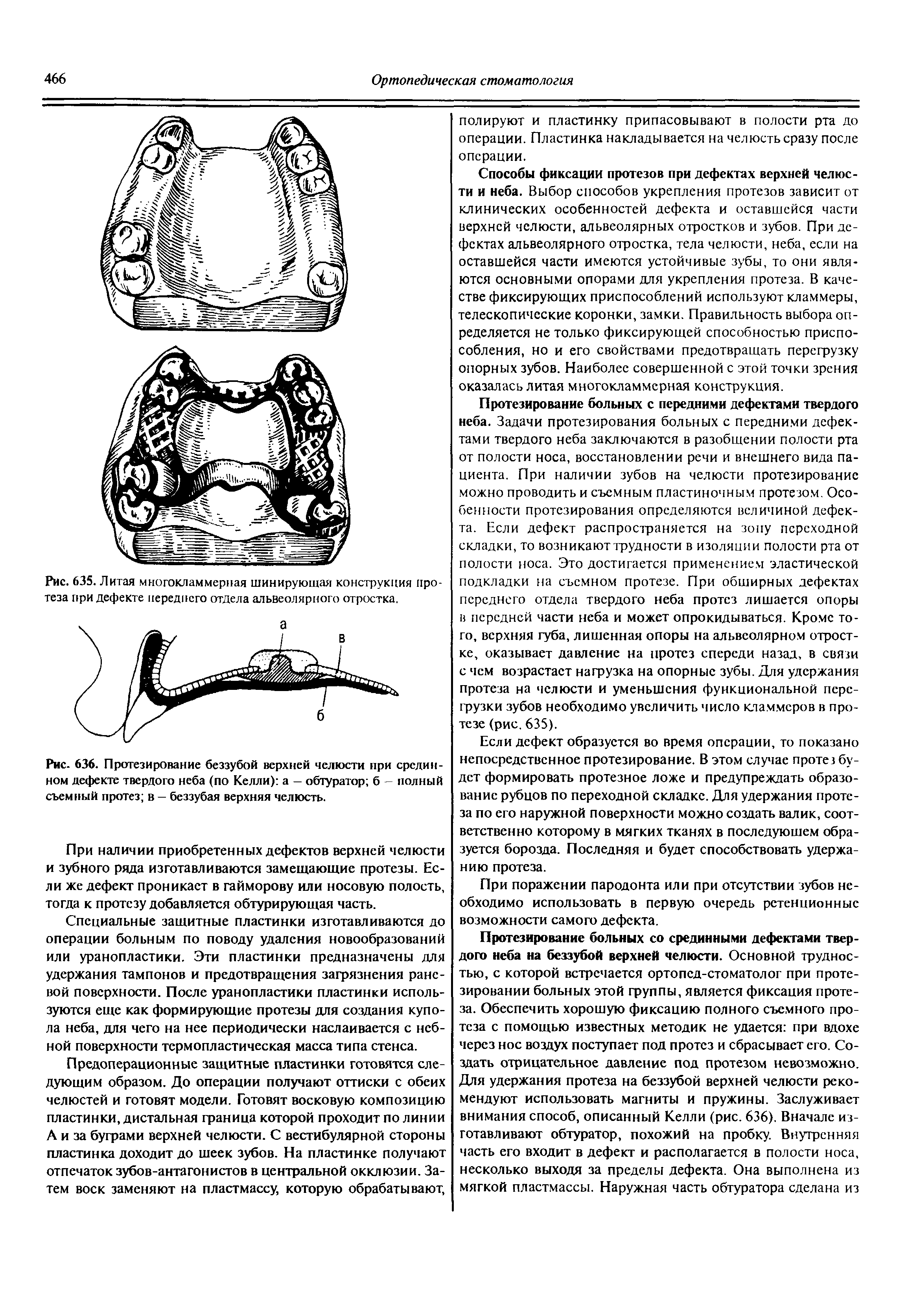 Рис. 636. Протезирование беззубой верхней челюсти при срединном дефекте твердого неба (по Келли) а - обтуратор б - полный съемный протез в — беззубая верхняя челюсть.