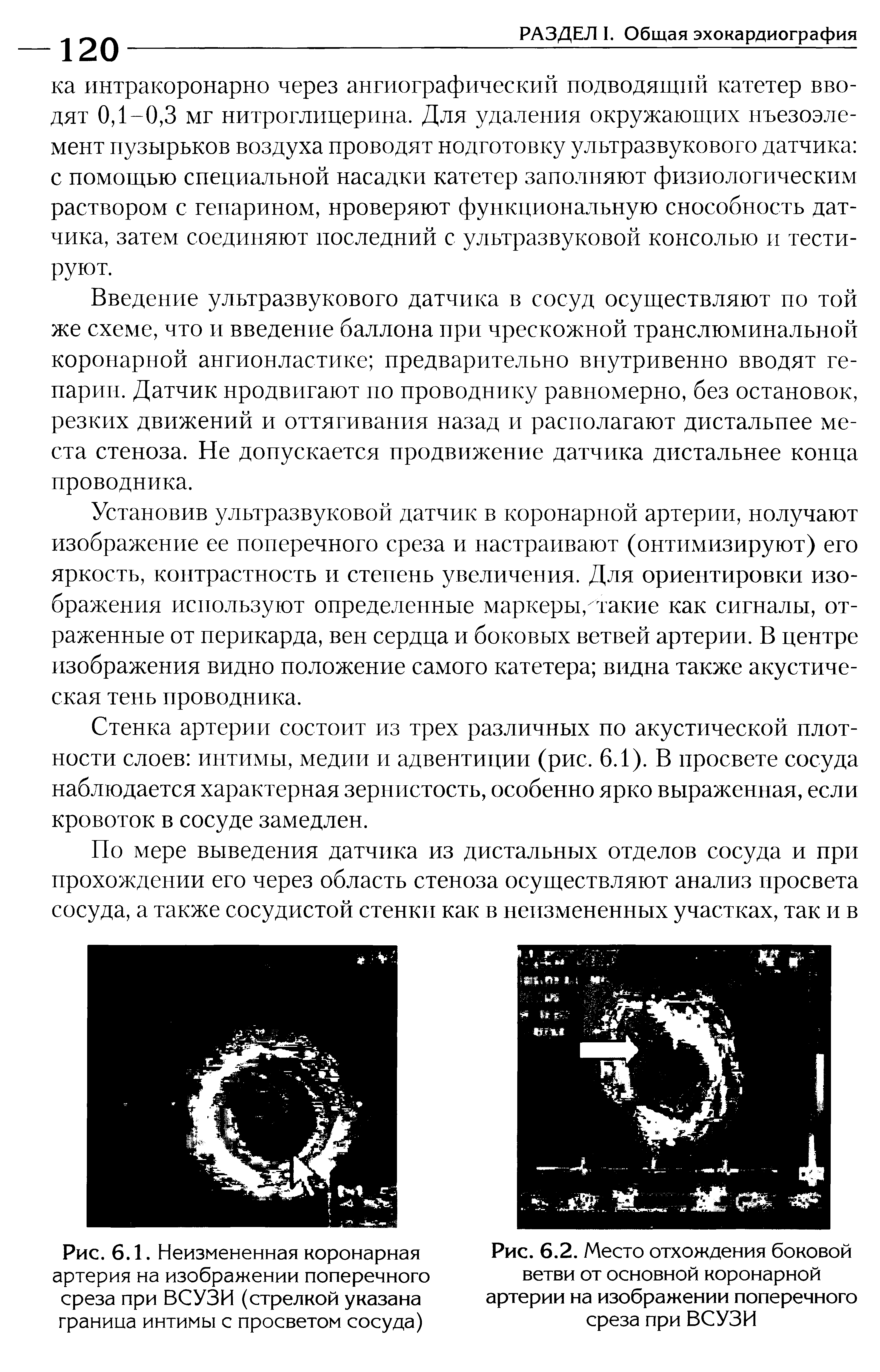 Рис. 6.1. Неизмененная коронарная артерия на изображении поперечного среза при ВСУЗИ (стрелкой указана граница интимы с просветом сосуда)...