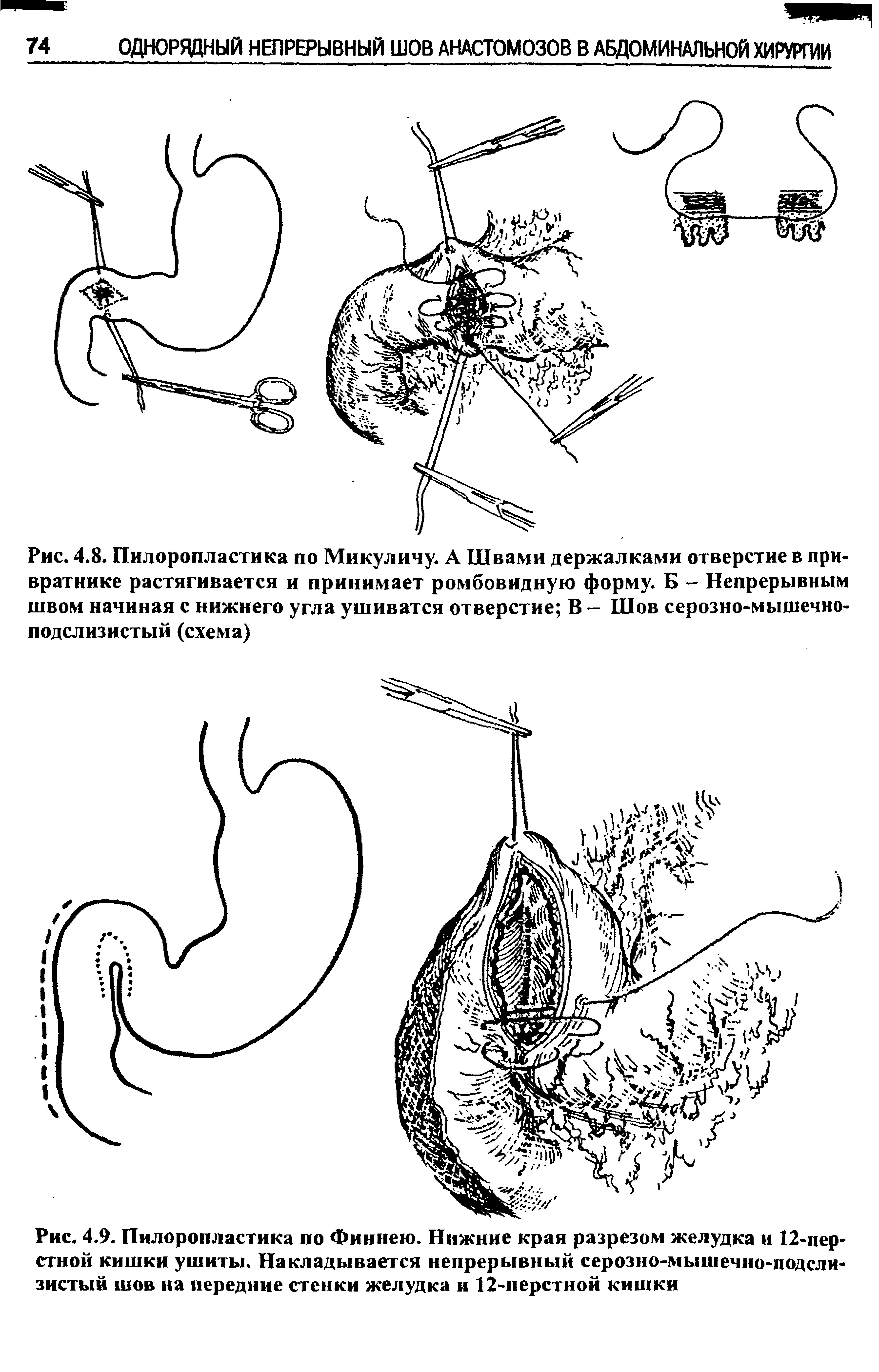 Рис. 4.9. Пилоропластика по Финнею. Нижние края разрезом желудка и 12-перстной кишки ушиты. Накладывается непрерывный серозно-мышечно-подслизистый шов на передние стенки желудка и 12-перстной кишки...