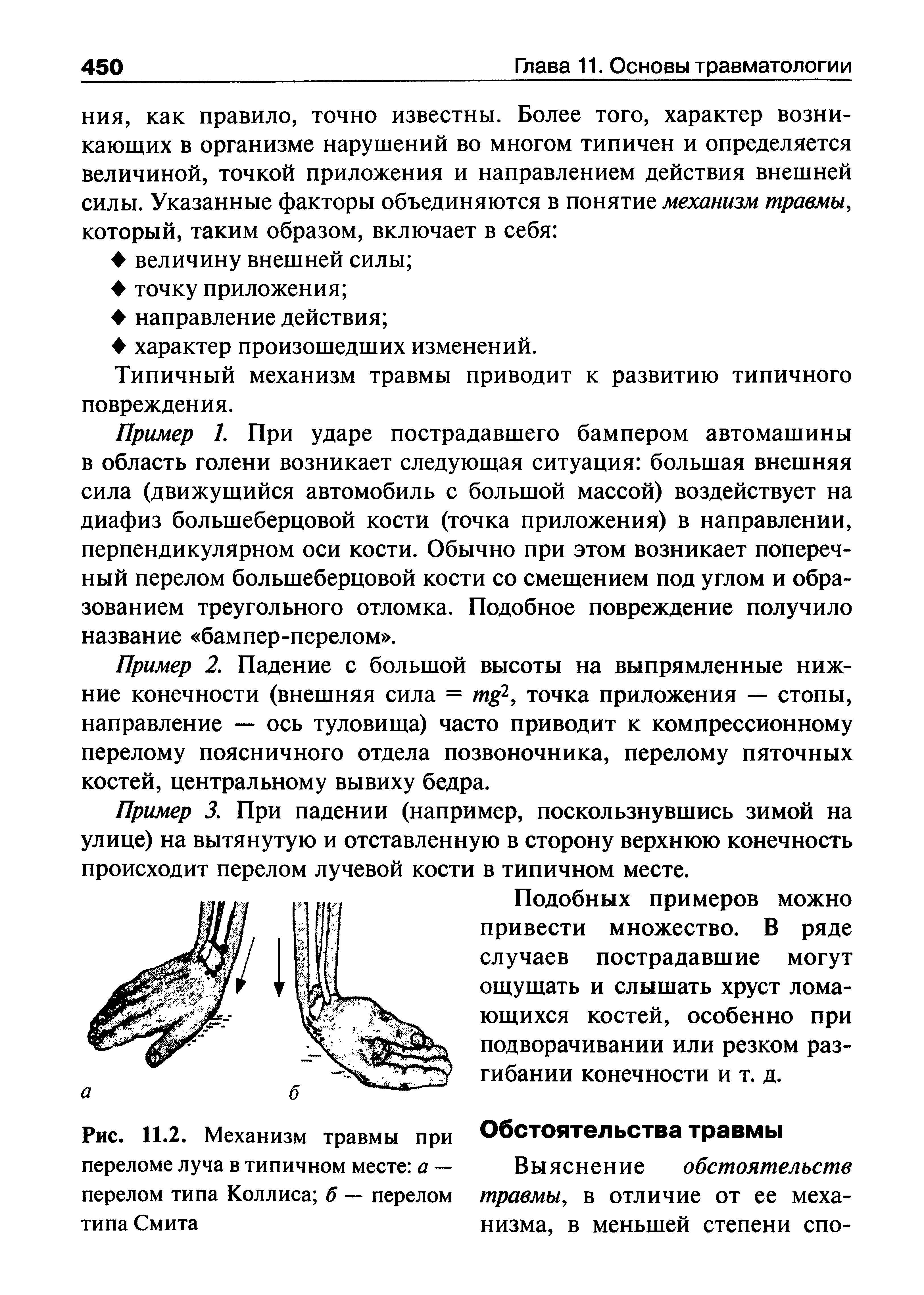 Рис. 11.2. Механизм травмы при переломе луча в типичном месте а — перелом типа Коллиса б — перелом типа Смита...