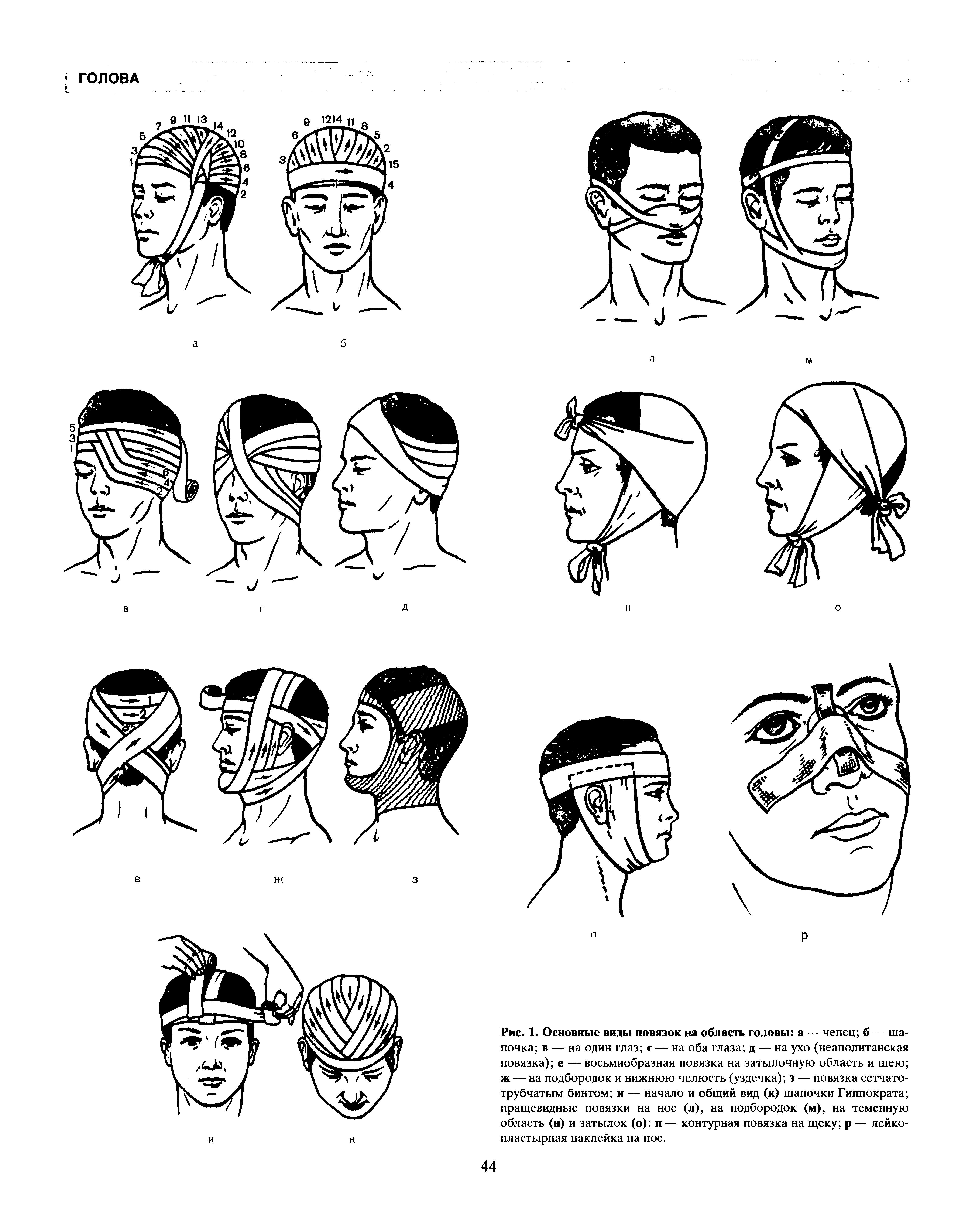 Виды головы. Повязка чепец Гиппократа. Неаполитанская шапочка повязка. Бинтование головы чепец. Перевязка головы бинтом чепец.