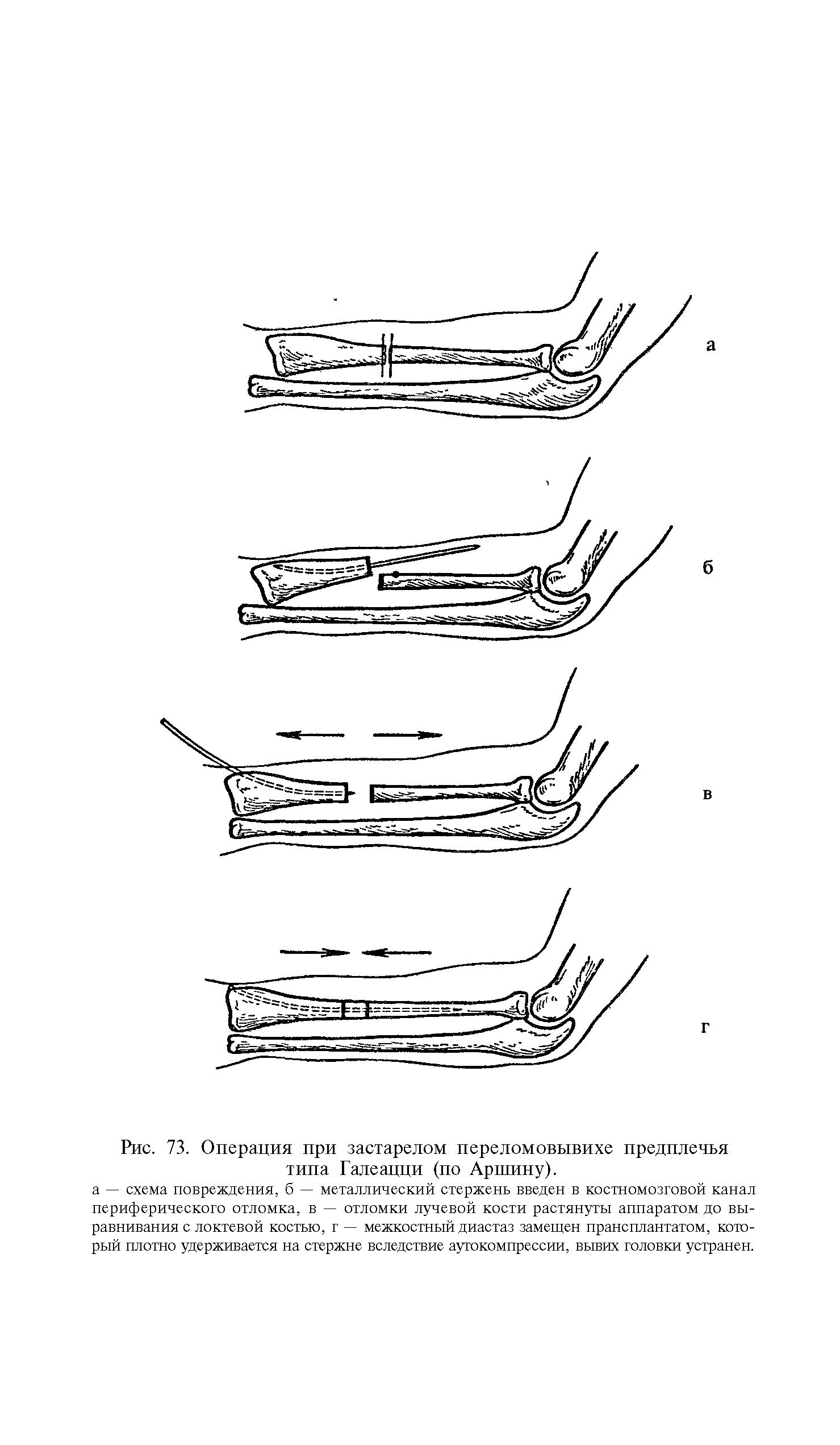 Рис. 73. Операция при застарелом переломовывихе предплечья типа Галеацци (по Аршину).
