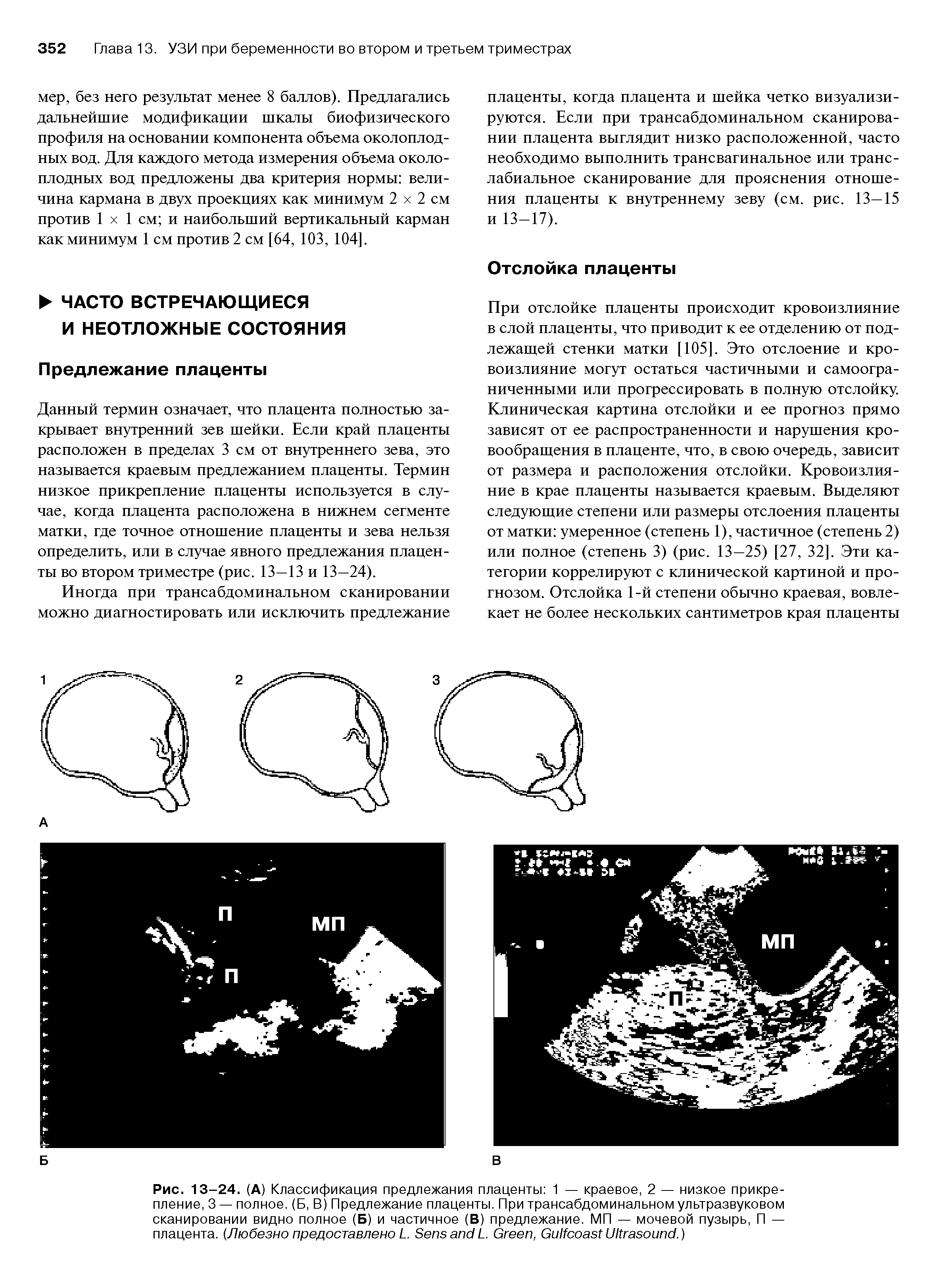 Рис. 13-24. (А) Классификация предлежания плаценты 1 — краевое, 2 — низкое прикрепление, 3 — полное. (Б, В) Предлежание плаценты. При трансабдоминальном ультразвуковом сканировании видно полное (Б) и частичное (В) предлежание. МП — мочевой пузырь, П — плацента. (Любезно предоставлено L. S L. G , G U .)...