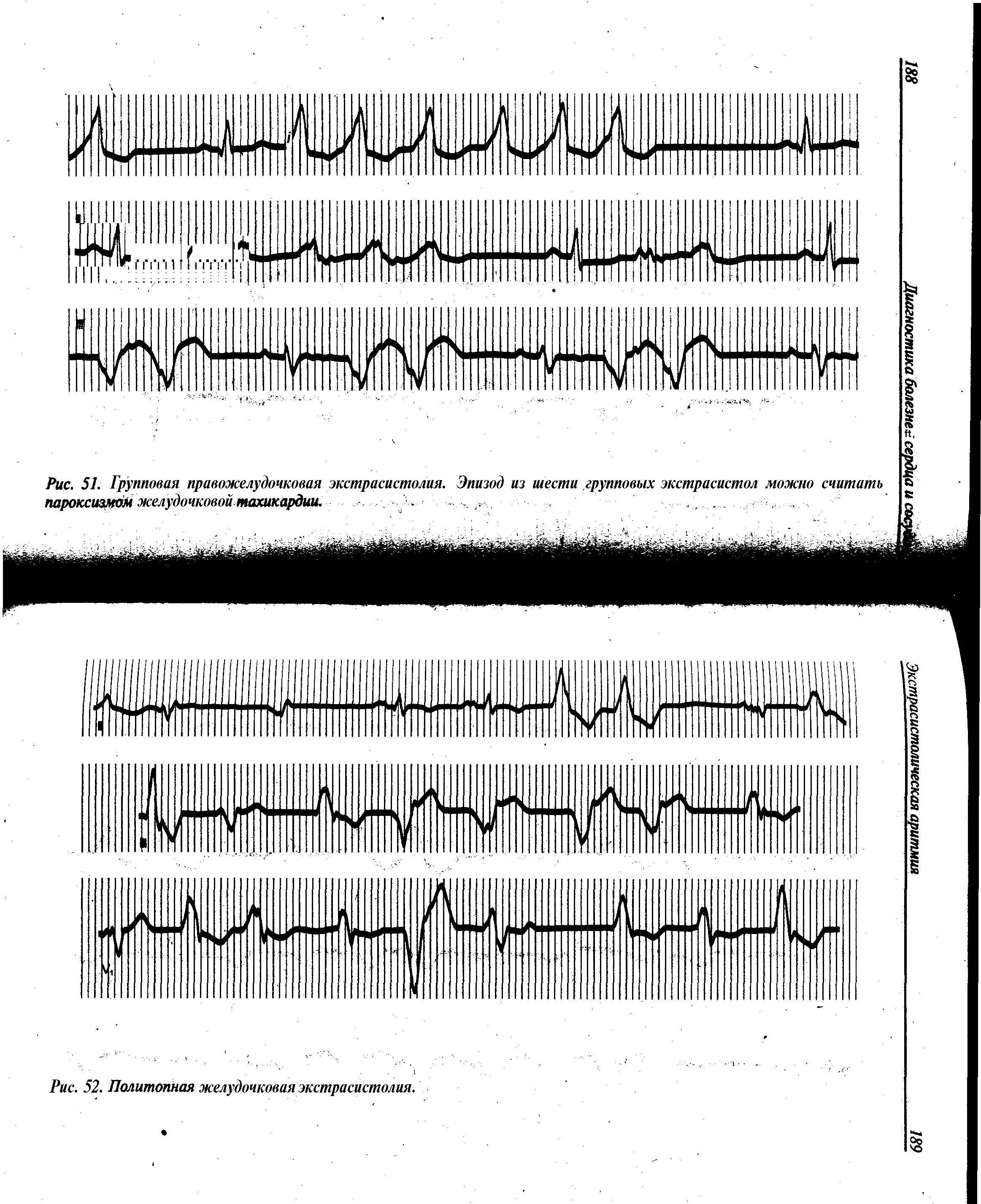 Рис. 51. Групповая правожелудочковая экстрасистолия. Эпизод из шести групповых экстрасистол можно считать пароксизмом желудочковой тахикардии.