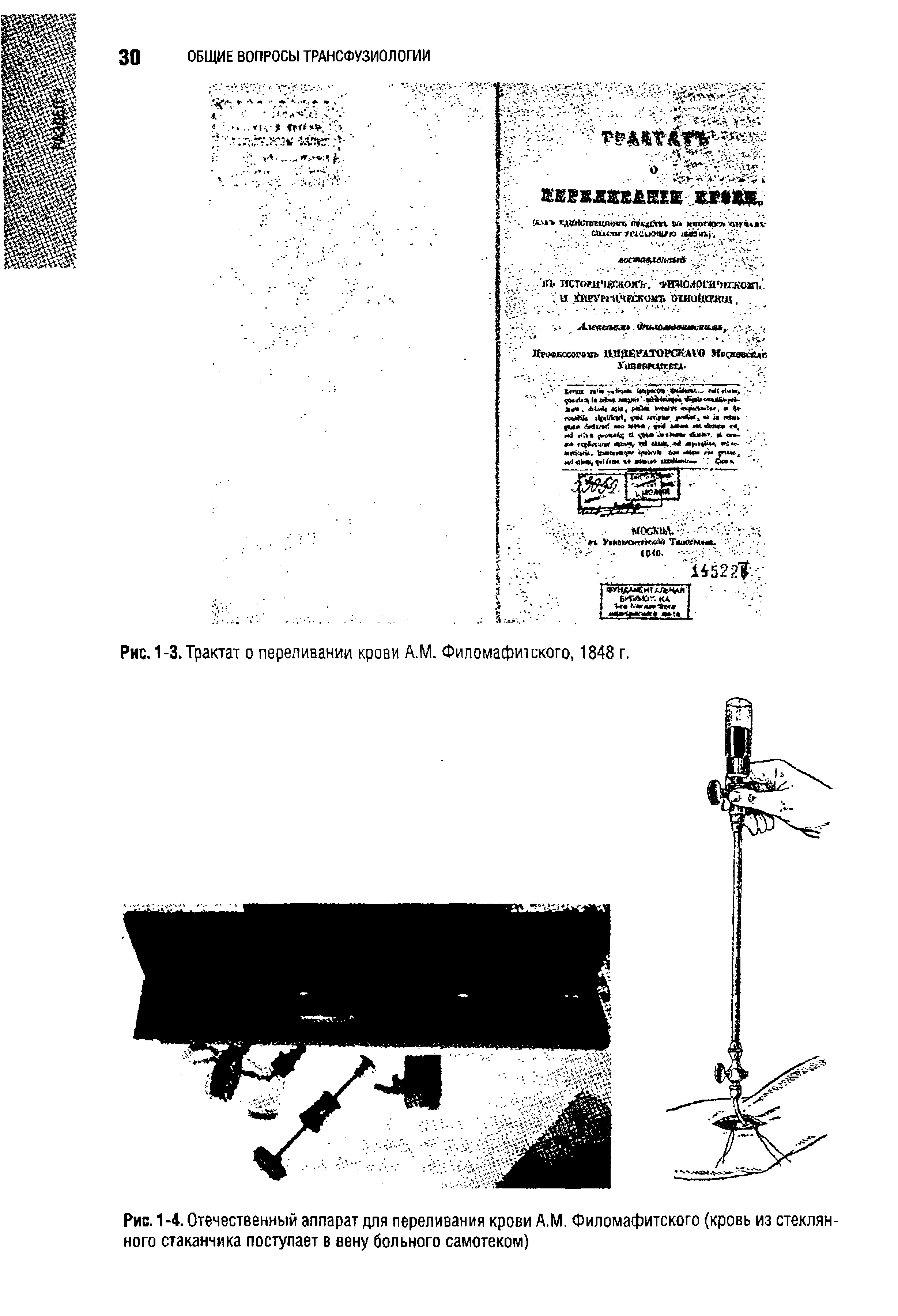 Рис. 1-4. Отечественный аппарат для переливания крови А.М. Филомафитского (кровь из стеклянного стаканчика поступает в вену больного самотеком)...