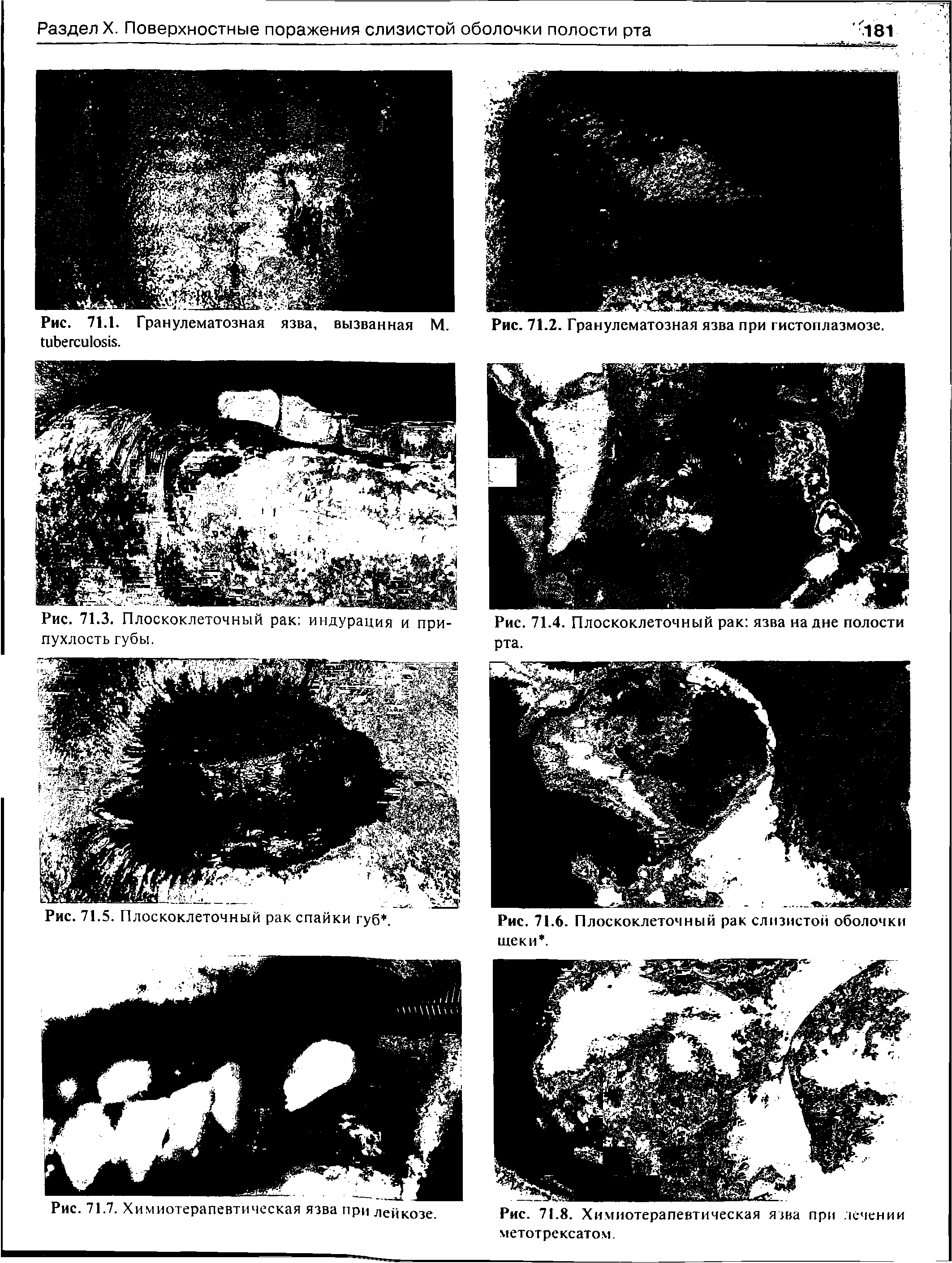 Рис. 71.1. Гранулематозная язва, вызванная М. Рис. 71.2. Гранулематозная язва при гистоплазмозе, .