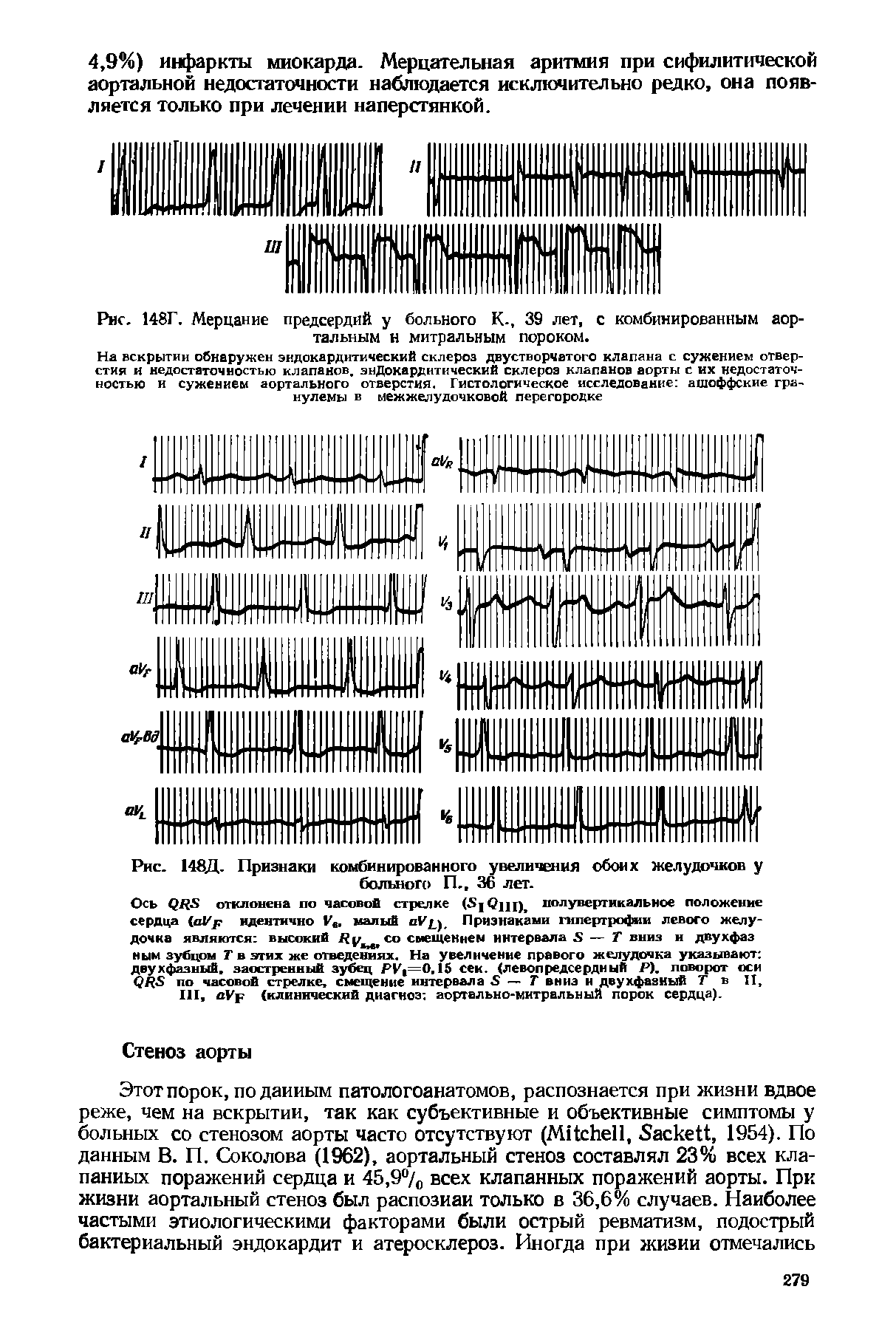 Рис. 148Г. Мерцание предсердий у больного К., 39 лет, с комбинированным аортальным н митральным пороком.