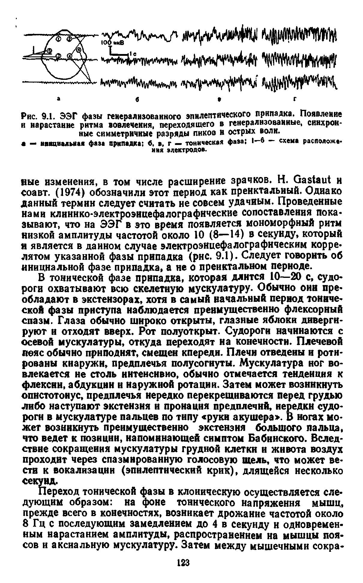 Рис. 9.1. ЭЭГ фазы генерализованного эпилептического припадка. Появление и нарастание ритма вовлечения, переходящего в генерализованные, синхронные симметричные разряды пиков и острых волн.