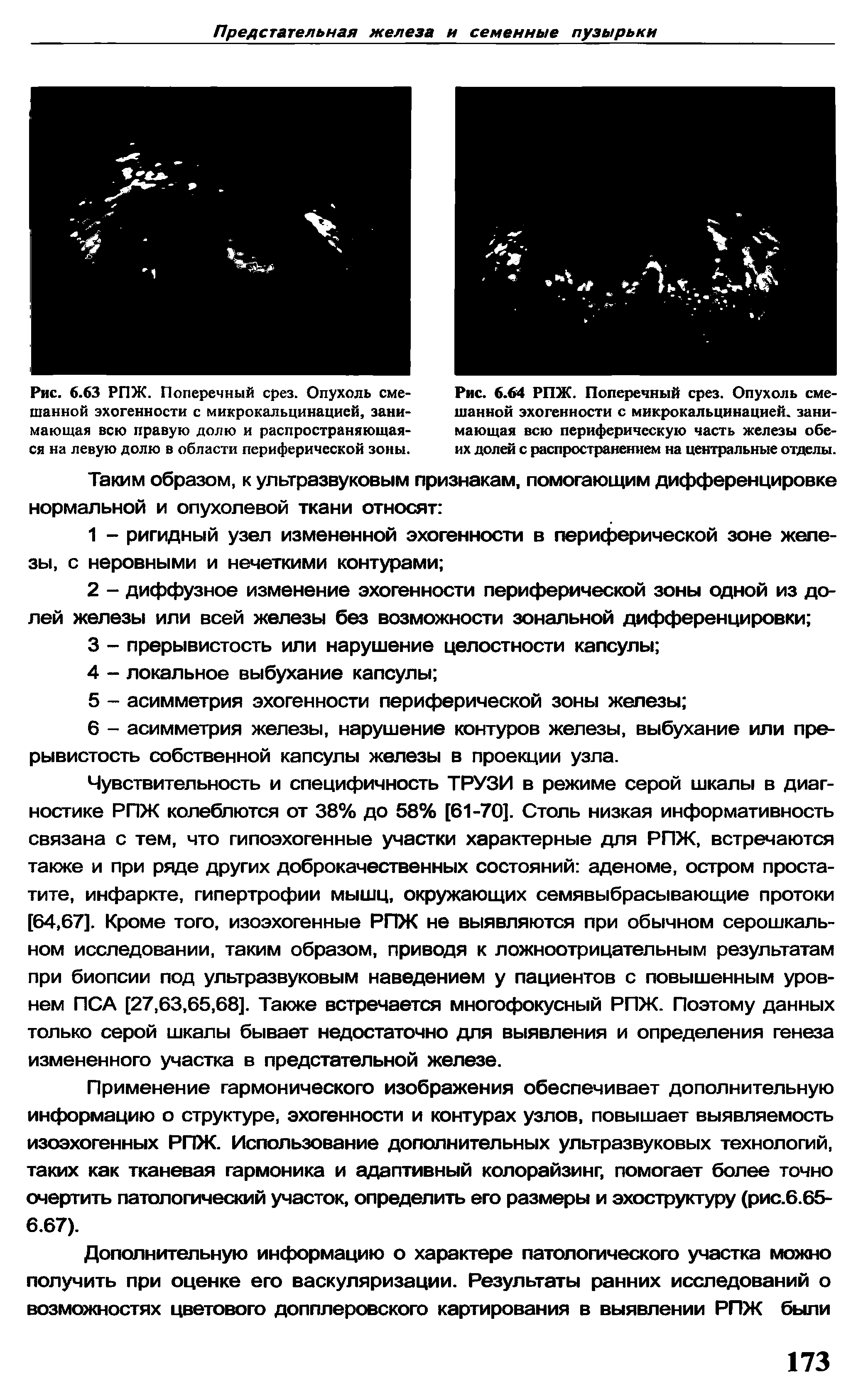 Рис. 6.63 РПЖ. Поперечный срез. Опухоль смешанной эхогенности с микрокальцинацией, занимающая всю правую долю и распространяющаяся на левую долю в области периферической зоны.