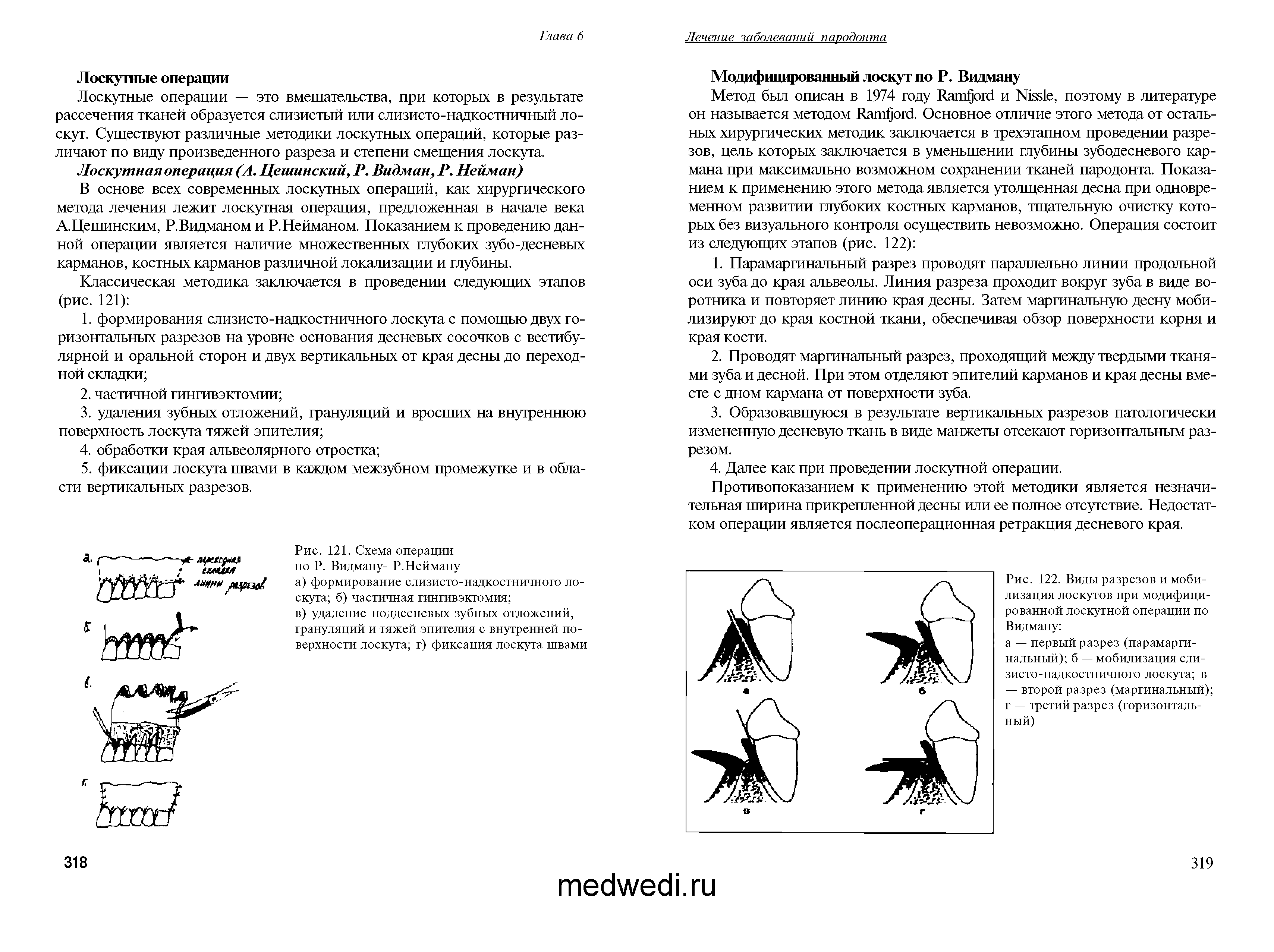 Рис. 121. Схема операции по Р. Видману- Р. Нейману а) формирование слизисто-надкостничного лоскута б) частичная гингивэктомия ...