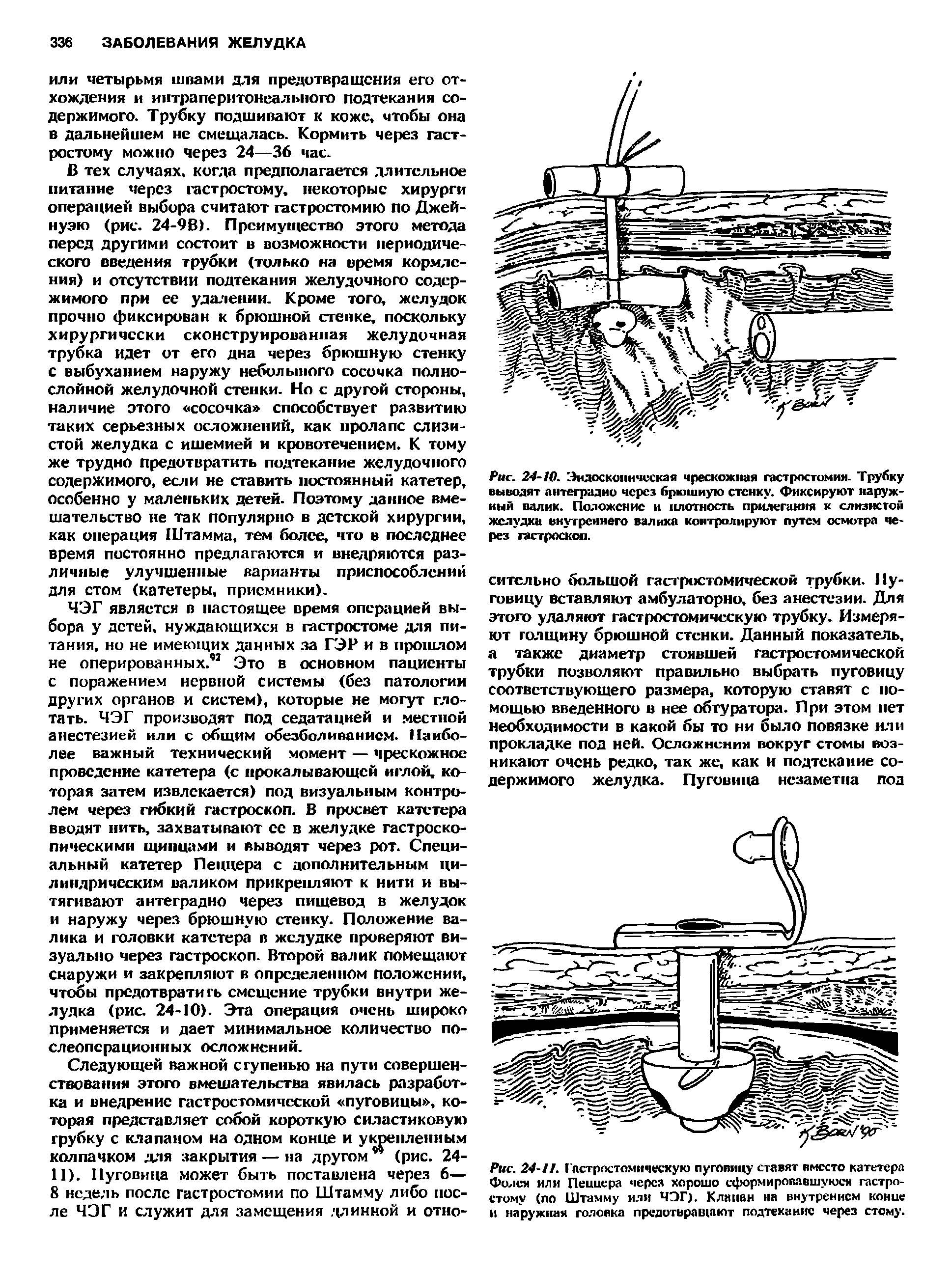 Рис. 24-10. Эндоскопическая чрескожная гастростомия. Трубку выводят антеградно через брюшную стенку. Фиксируют наружный валик. Положение и плотность прилегания к слизистой желудка внутреннего валика контролируют путем осмотра через гастроскоп.