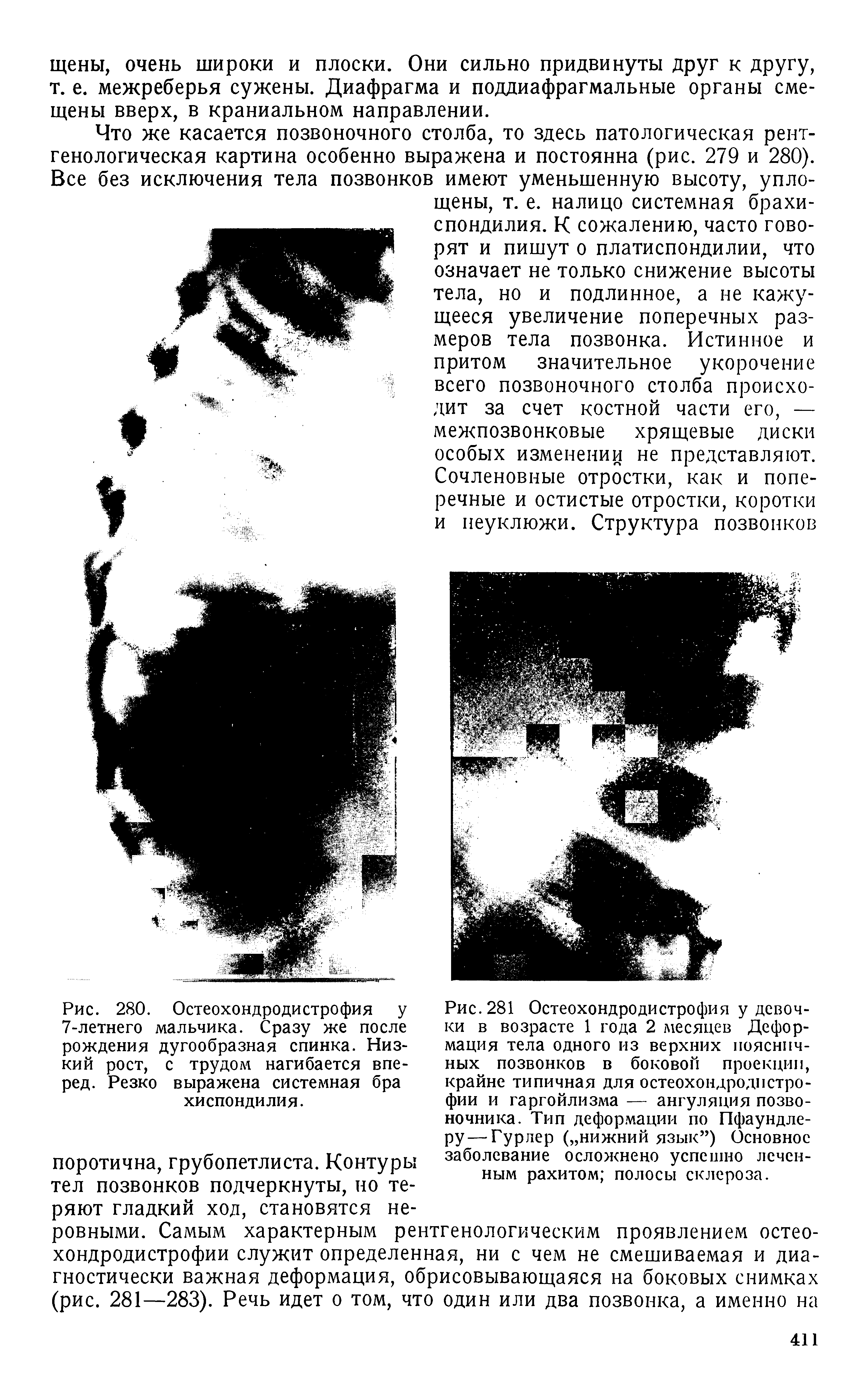 Рис. 281 Остеохондродистрофия у девочки в возрасте 1 года 2 месяцев Деформация тела одного из верхних поясничных позвонков в боковой проекции, крайне типичная для остеохондродистрофии и гаргойлизма — ангуляция позвоночника. Тип деформации по Пфаундле-РУ—Гурлер ( нижний язык ) Основное заболевание осложнено успешно леченным рахитом полосы склероза.