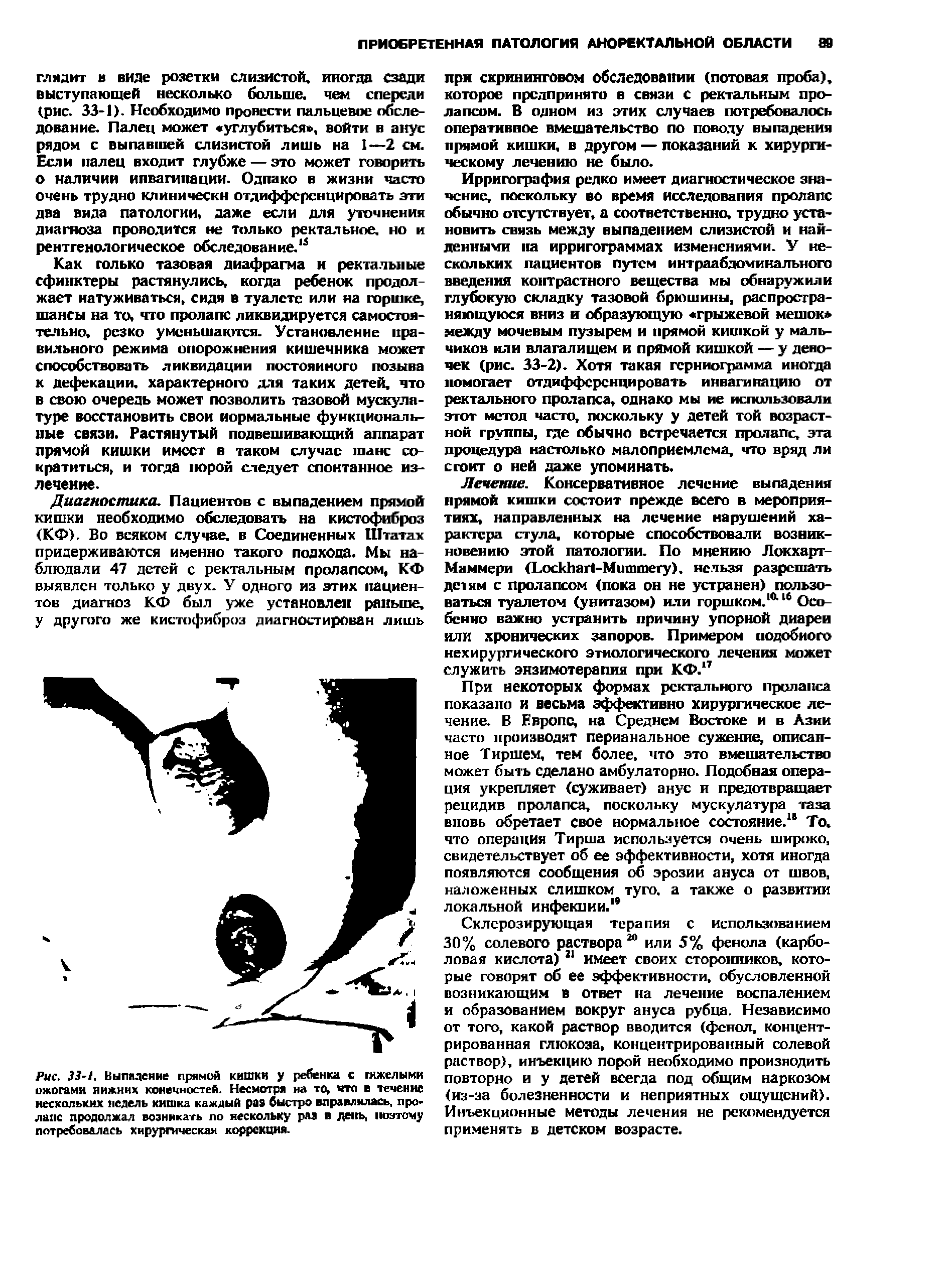 Рис. 33-1. Выпадение прямой кишки у ребенка с гкжелыми ожогами яижннх конечностей. Несмотря на то, что в течение нескольких недель кишка каждый раз быстро вправлялась, пролапс продолжал возникать по нескольку раз и день, поэтому потребовалась хирургическая коррекция.