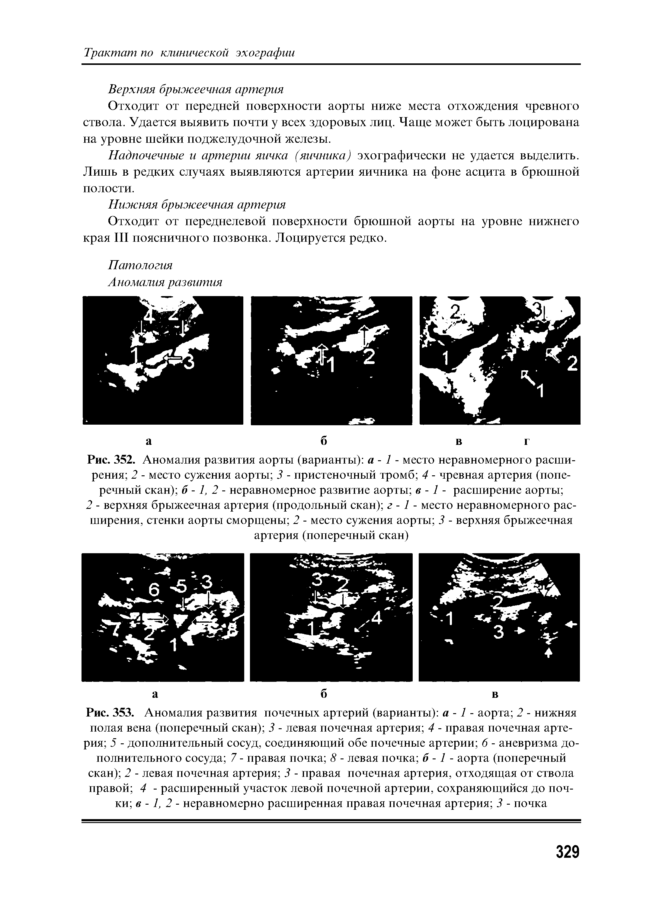 Рис. 352. Аномалия развития аорты (варианты) а - 1 - место неравномерного расширения 2 - место сужения аорты 3 - пристеночный тромб 4 - чревная артерия (поперечный скан) 6-1,2- неравномерное развитие аорты в -1 - расширение аорты ...