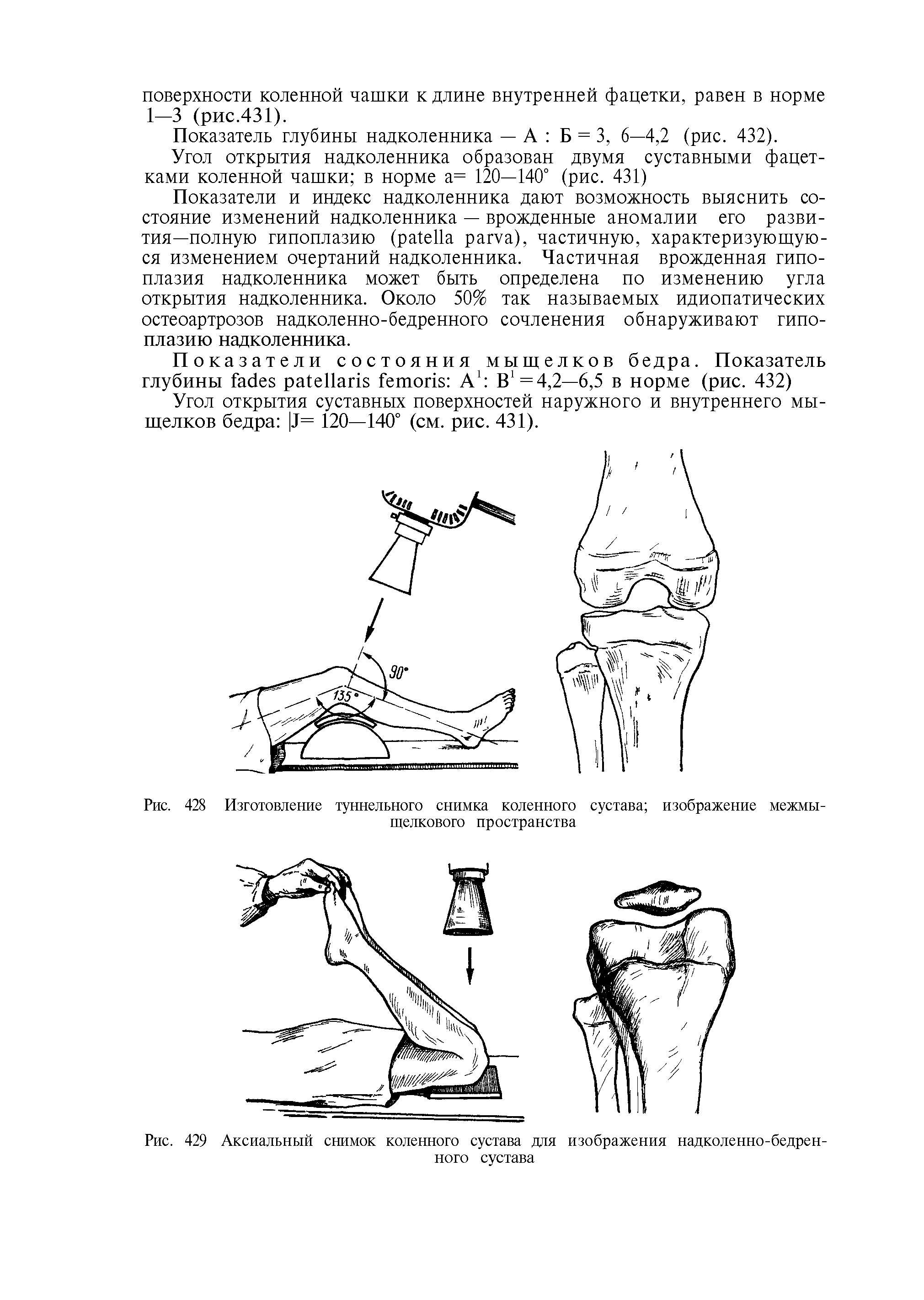 Рис. 428 Изготовление туннельного снимка коленного сустава изображение межмыщелкового пространства...