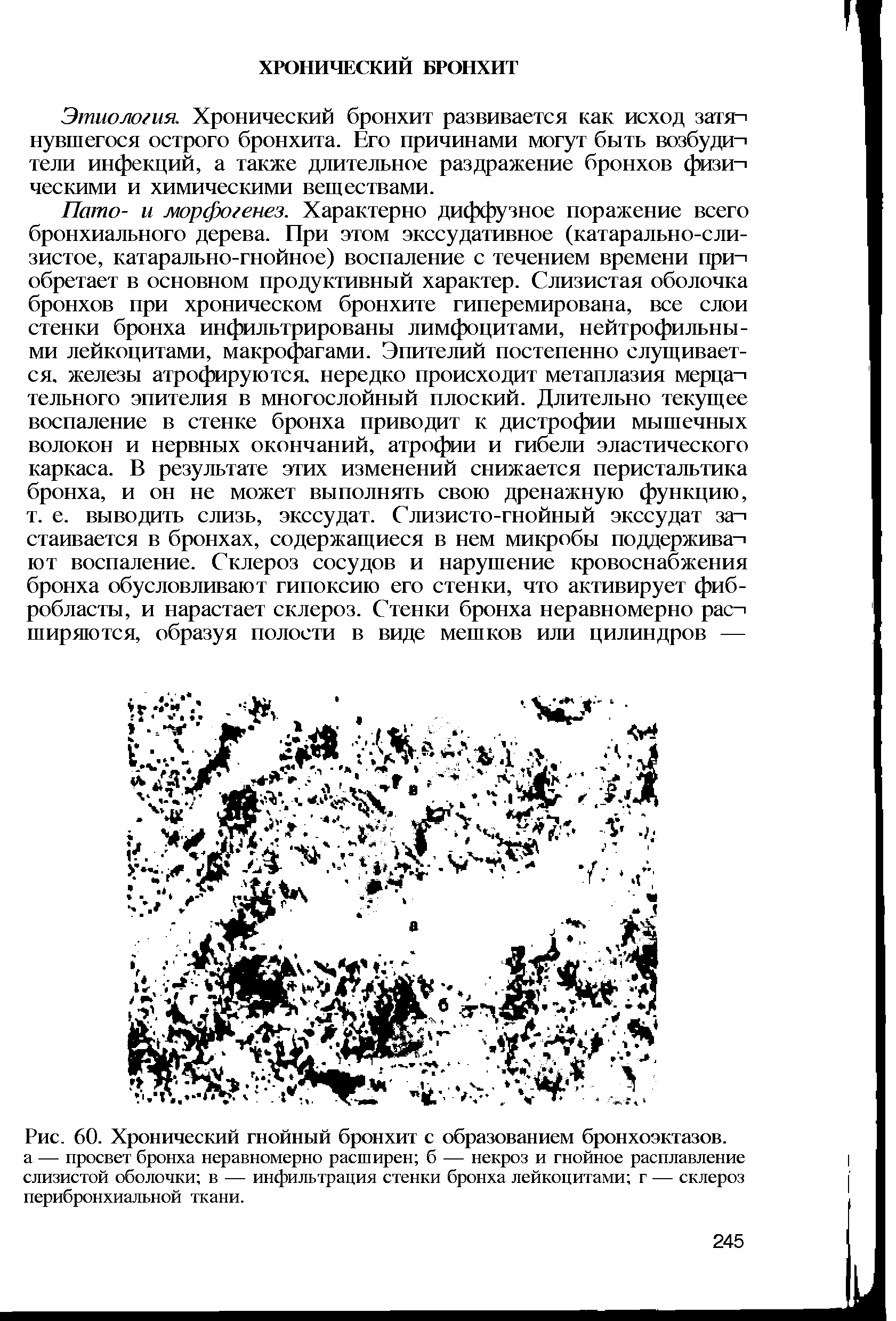 Рис. 60. Хронический гнойный бронхит с образованием бронхоэктазов, а — просвет бронха неравномерно расширен б — некроз и гнойное расплавление слизистой оболочки в — инфильтрация стенки бронха лейкоцитами г — склероз перибронхиальной ткани.