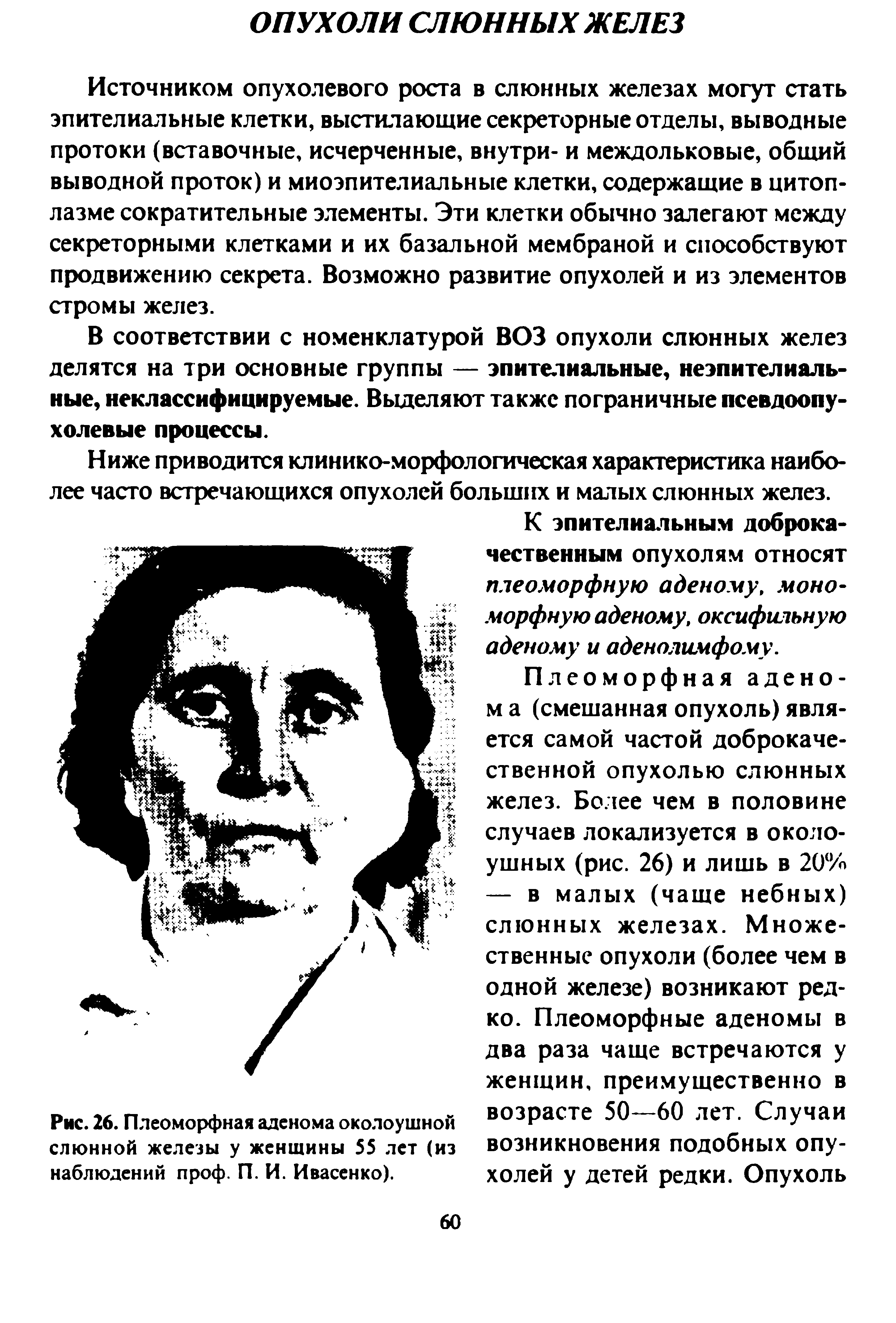 Рис. 26. Плеоморфная аденома околоушной слюнной железы у женщины 55 лет (из наблюдений проф. П. И. Ивасенко).