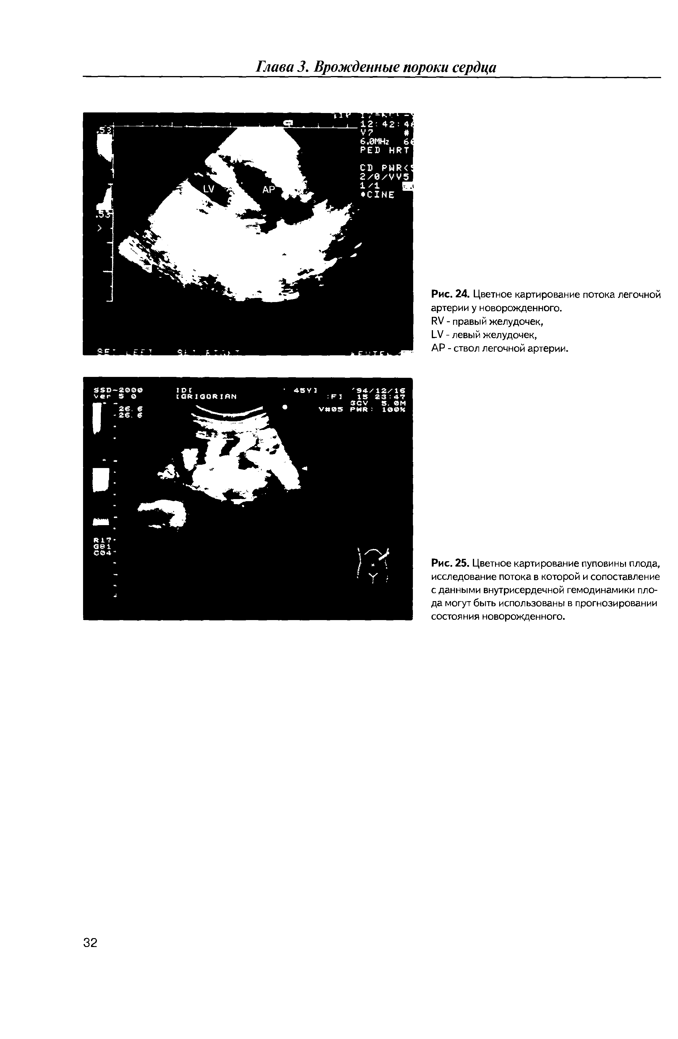 Рис. 25. Цветное картирование пуповины плода, исследование потока в которой и сопоставление сданными внутрисердечной гемодинамики плода могут быть использованы в прогнозировании состояния новорожденного.