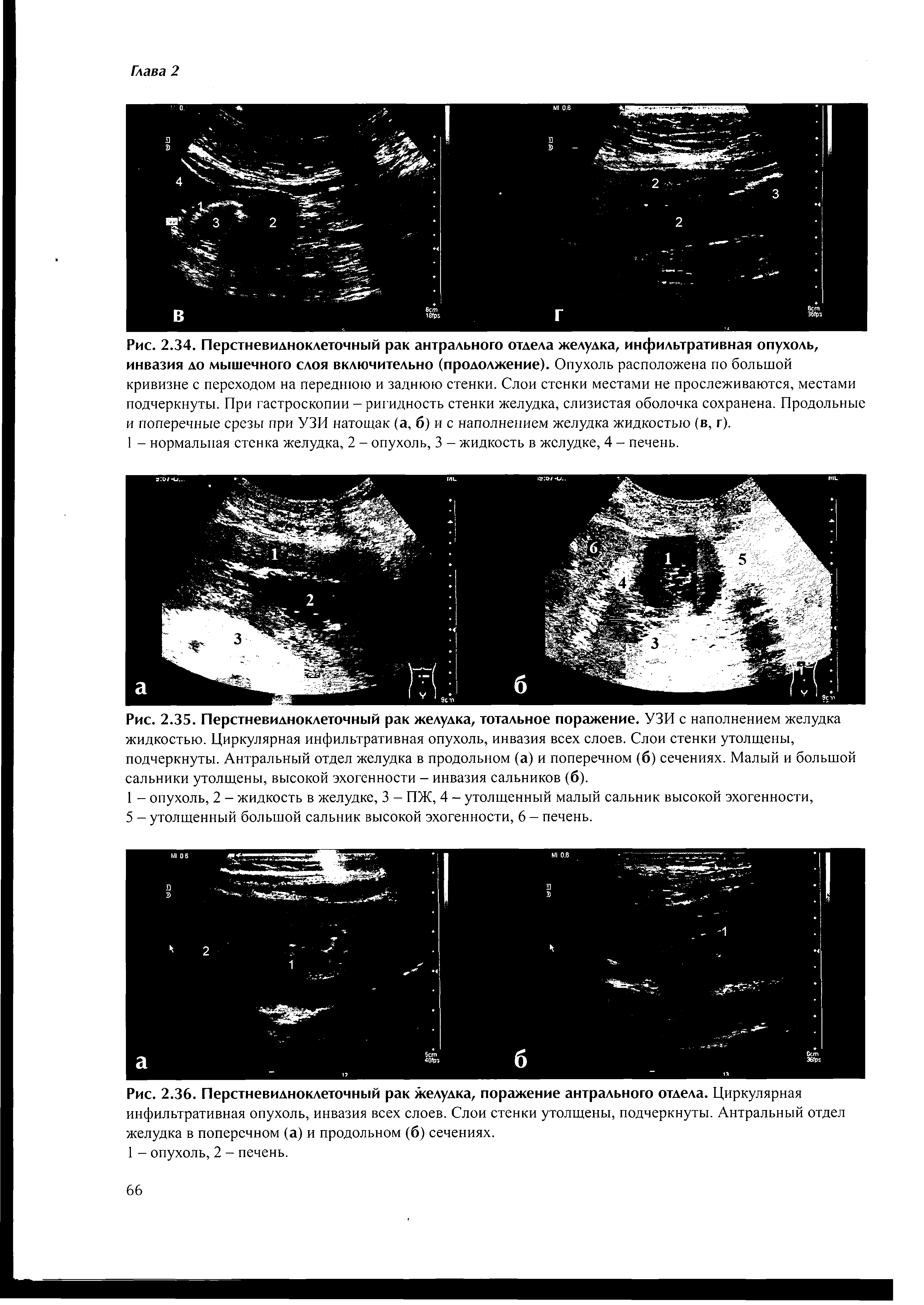 Рис. 2.35. Перстневидноклеточный рак желудка, тотальное поражение. УЗИ с наполнением желудка жидкостью. Циркулярная инфильтративная опухоль, инвазия всех слоев. Слои стенки утолщены, подчеркнуты. Антральный отдел желудка в продольном (а) и поперечном (б) сечениях. Малый и большой сальники утолщены, высокой эхогенности - инвазия сальников (б).
