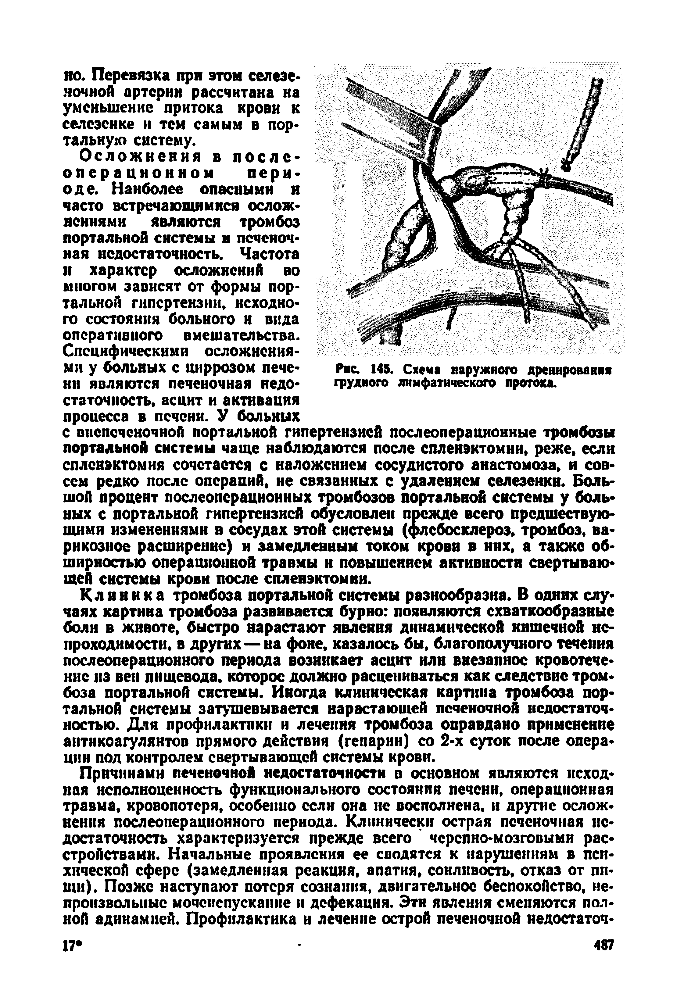 Рис. 145. Схеча наружного дренирования грудного лимфатического протока.