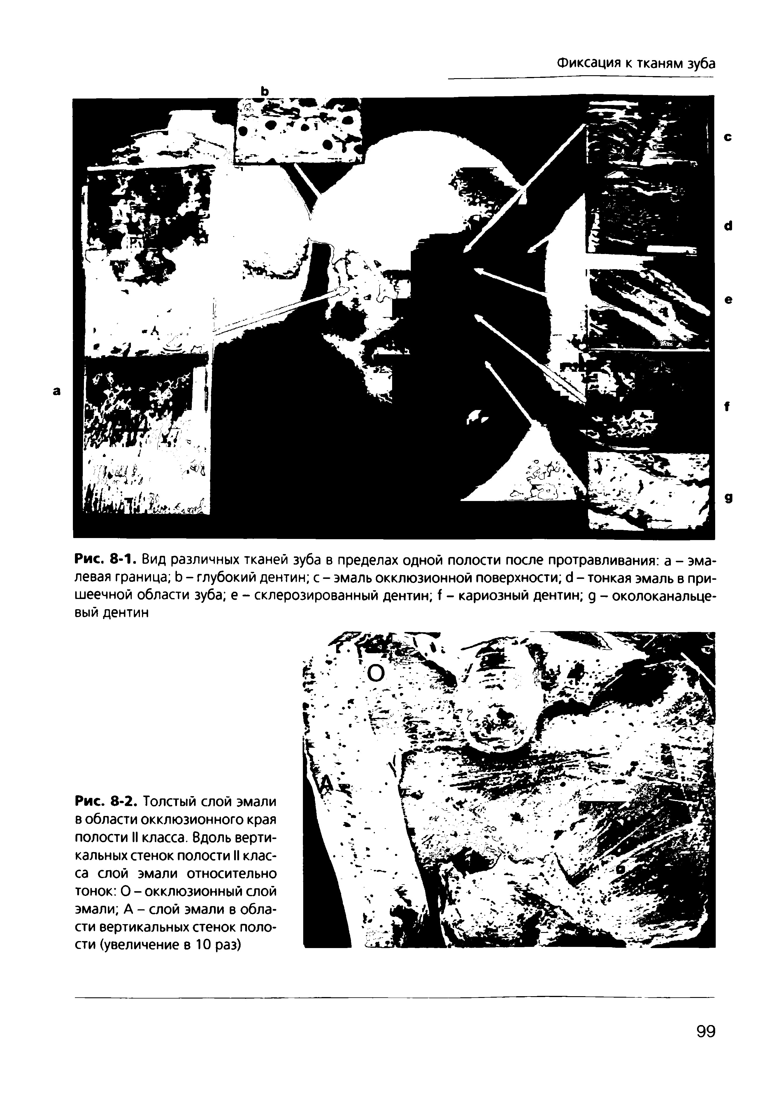 Рис. 8-1. Вид различных тканей зуба в пределах одной полости после протравливания а - эмалевая граница Ь - глубокий дентин с - эмаль окклюзионной поверхности с1 - тонкая эмаль в пришеечной области зуба е - склерозированный дентин I - кариозный дентин д - околоканальце-вый дентин...