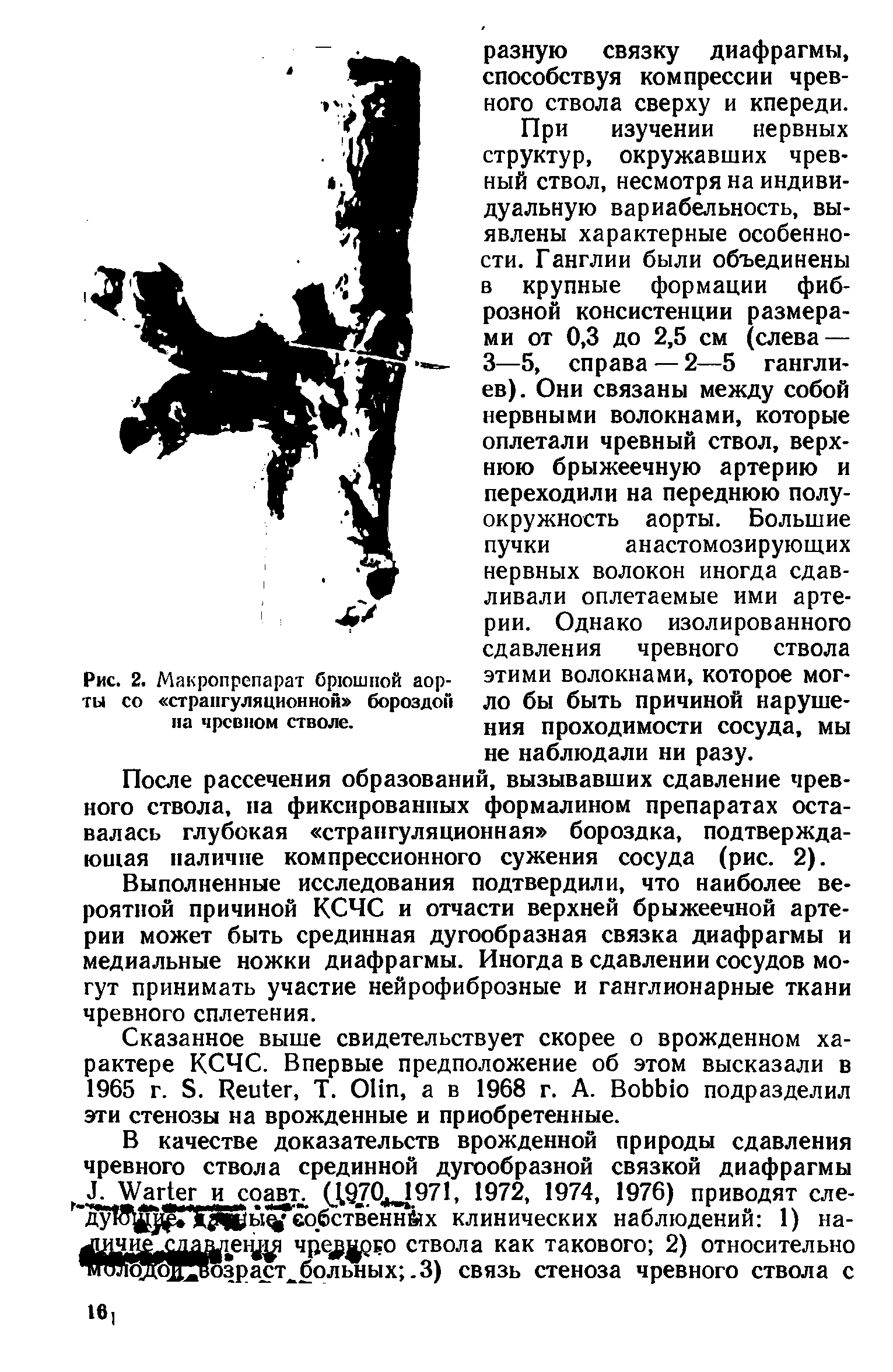 Рис. 2. Макропрепарат брюшной аорты со странгуляционной бороздой на чревном стволе.