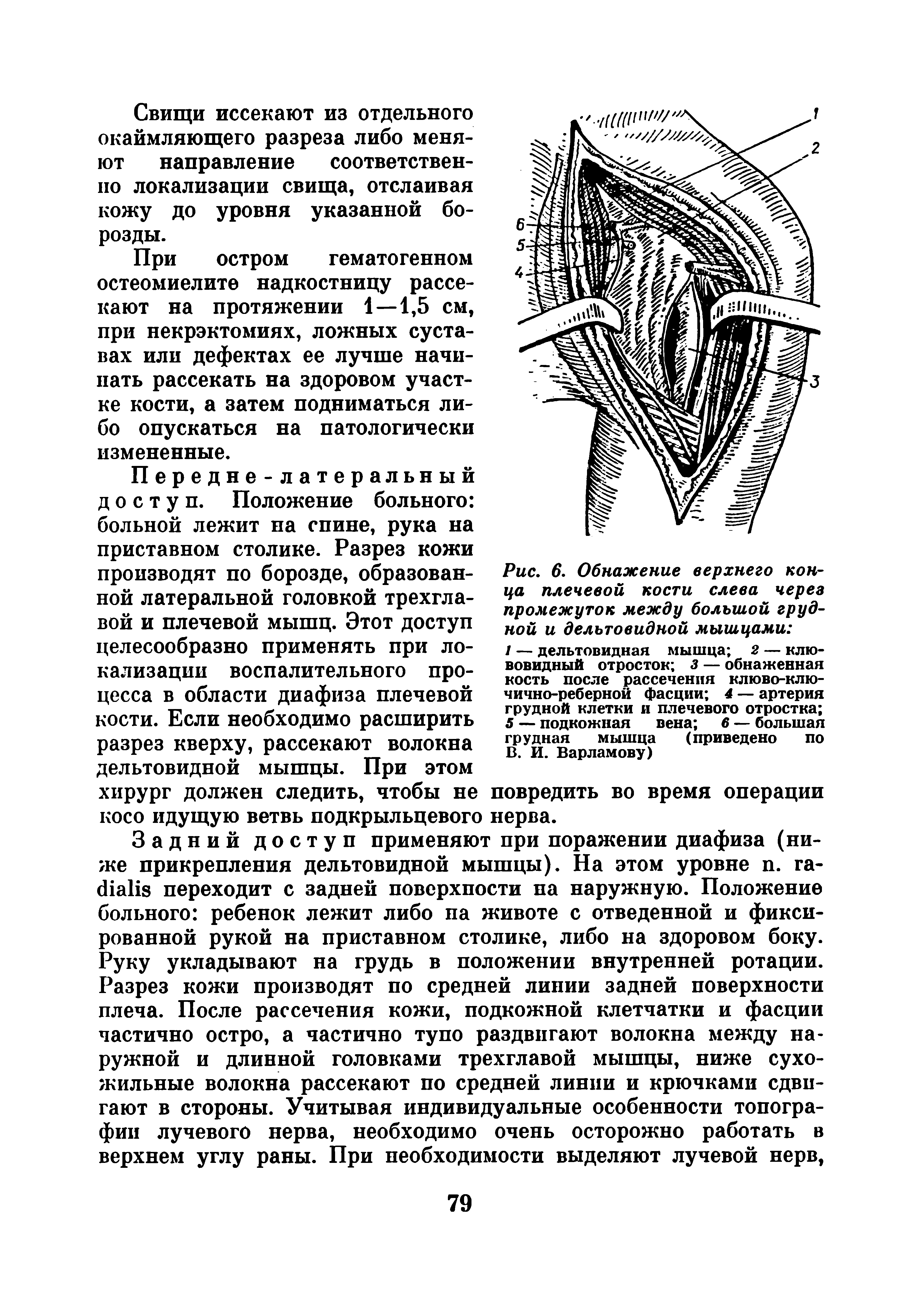 Рис. 6. Обнажение верхнего конца плечевой кости слева через промежуток между большой грудной и дельтовидной мышцами ...