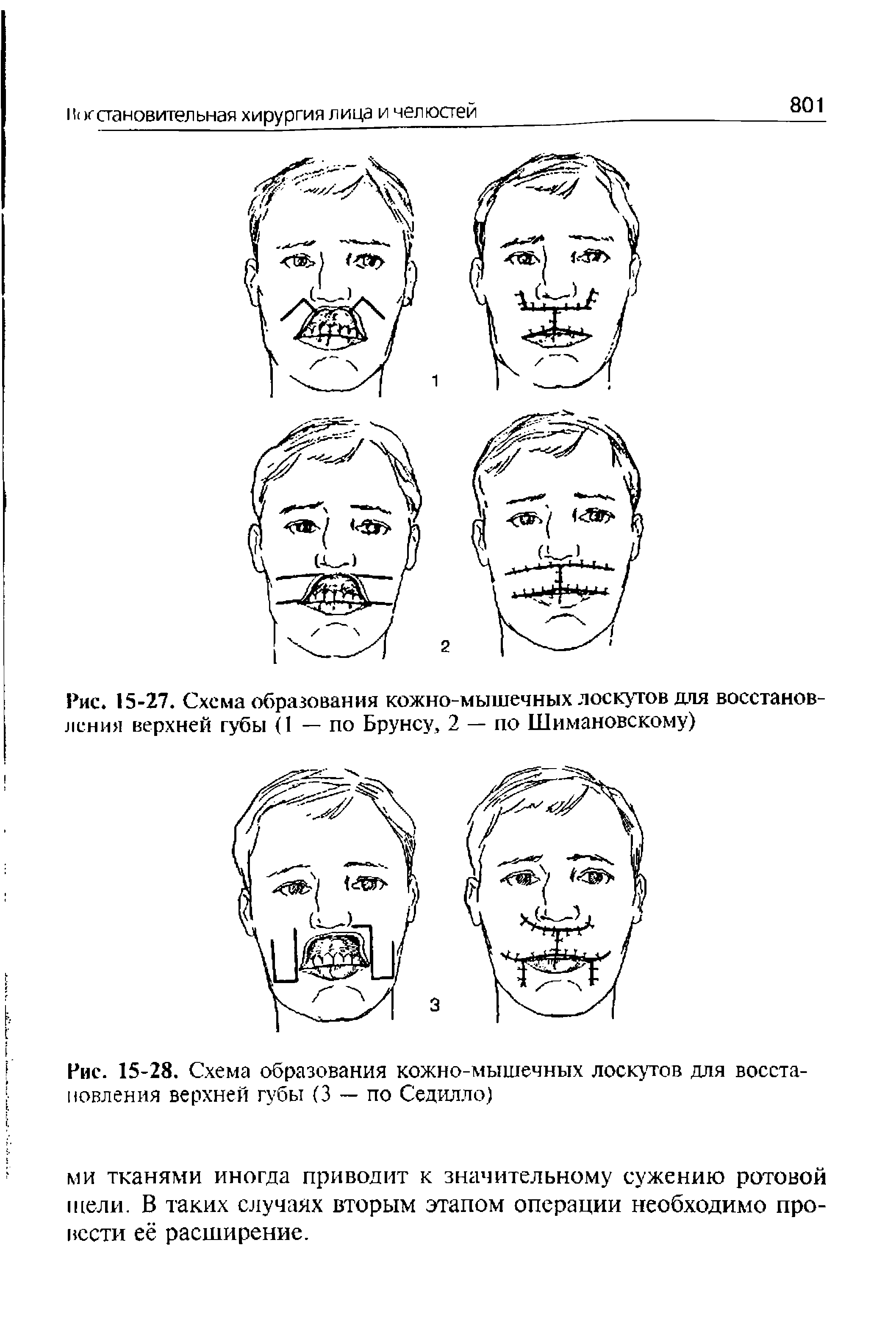 Рис. 15-28. Схема образования кожно-мышечных лоскутов для восстановления верхней губы (3 — по Седилло)...