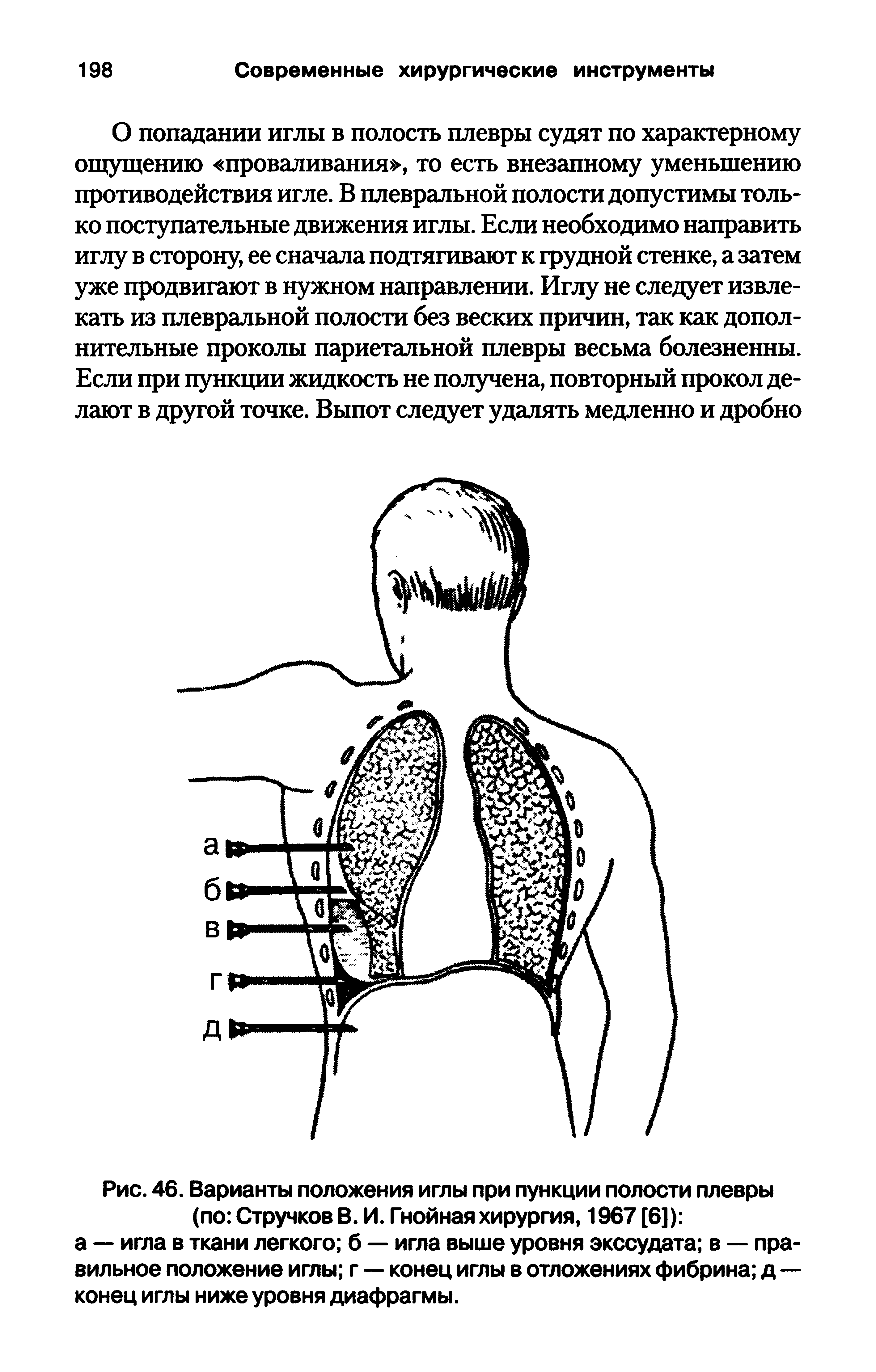 Рис. 46. Варианты положения иглы при пункции полости плевры (по Стручков В. И. Гнойная хирургия, 1967 [6]) а — игла в ткани легкого б — игла выше уровня экссудата в — правильное положение иглы г — конец иглы в отложениях фибрина д— конец иглы ниже уровня диафрагмы.